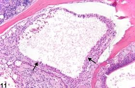 Brain Necrosis Nonneoplastic Lesion Atlas