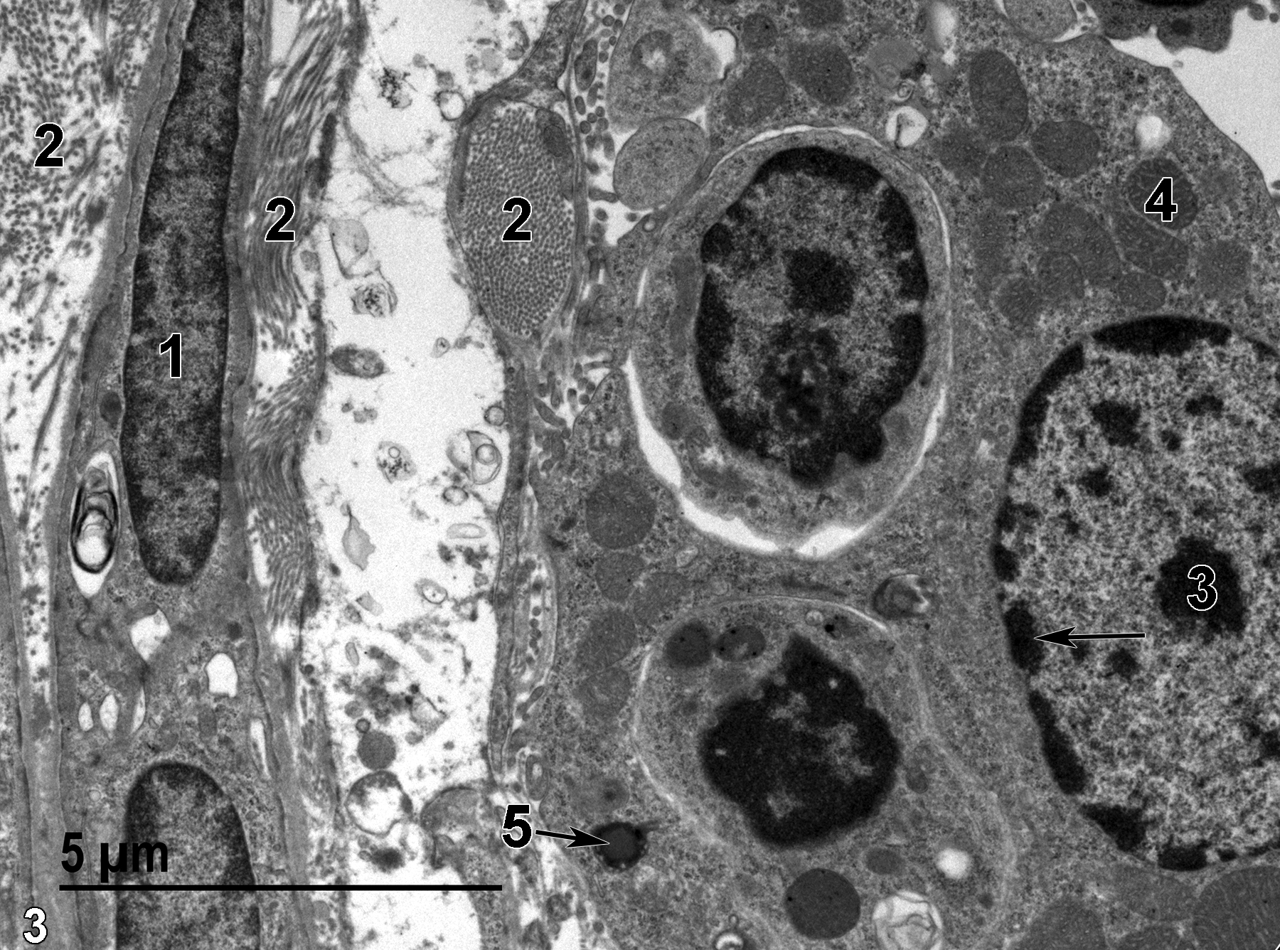 <strong>Figure 3.</strong> A higher magnification view of the region shown in Figure 2. The smooth muscle cell within the capsular layer (1) is associated with clusters of collagen (2). The nucleus of an epithelial cell has a single nucleolus (3) and marginated heterochromatin (arrow). The cytoplasm has a number of mitochondria (4). A relatively rare lipid droplet (5, arrow) is shown. 9300x.