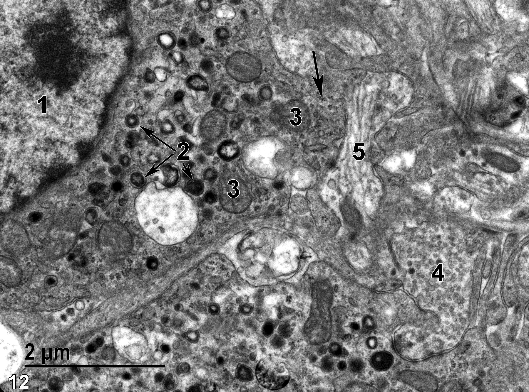<strong>Figure 12.</strong> Two norepinephrine cells of the medullary layer. One contains a nucleus (1) with a prominent nucleolus and marginated heterochromatin, as well as a variable population of secretory granules, many with electron-lucent central cores (2, arrows). Mitochondria (3) have elongated tubular cristae. An area of neural cell processes is to the right of the upper norepinephrine cell. Some contain synaptic vesicles (4), whereas others are filled with microtubules and a few vesicles (5). Particulate glycogen clusters are found throughout the cytoplasm (arrow). 18500x.
