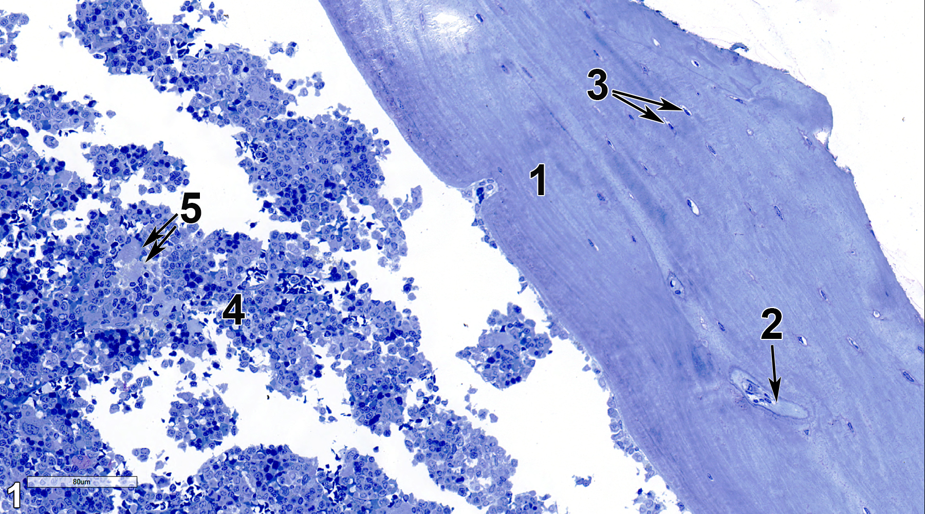 <strong>Figure 1.</strong> A semithin section (0.5 micrometer thick) of a toluidine blue O-stained section showing cortical bone (1) with a Haversian canal (2, arrow), lacunae containing osteocytes (3, double arrows), and bone marrow (4), containing a variety of progenitor cells, erythrocytes, leukocytes, and megakaryocytes (5, double arrows). 25x.