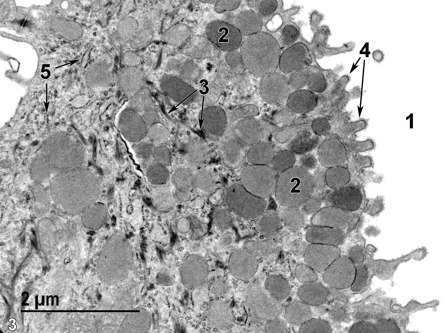 <strong>Figure 3.</strong> A higher magnification view of a single mucus cell showing the cervical lumen (1), mucigen granules (2) of varying density, bundles of tonofilaments (3, arrows), microvilli with glycocalyx materials associated with their plasma membranes (4, arrows), and rough endoplasmic reticulum elements (5, arrows). 8500x.
