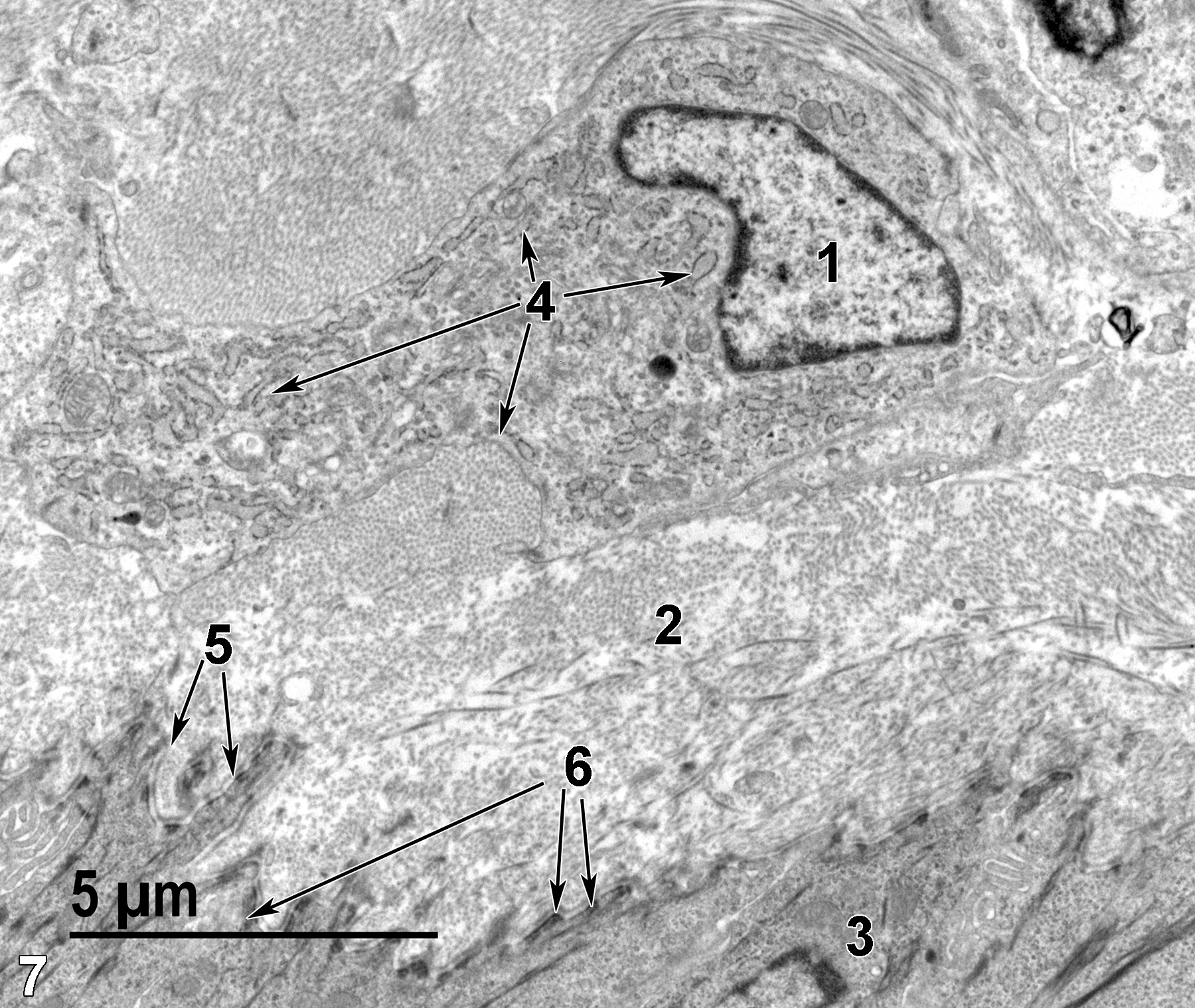 <strong>Figure 7.</strong> A portion of the lamina propria is shown. A fibroblast nucleus (1) is shown. The cytoplasm of the fibroblast is filled with a large quantity of rough endoplasmic reticulum (4, arrows). Collagen fibrils (2) are the predominant element of the lamina propria. At the bottom of the image are the most basal cells (3) of the stratified epithelium. The electron densities scattered along the junction of the cell membrane and the basal lamina (5, arrows) are hemidesmosomes (6, arrows). 6800x.