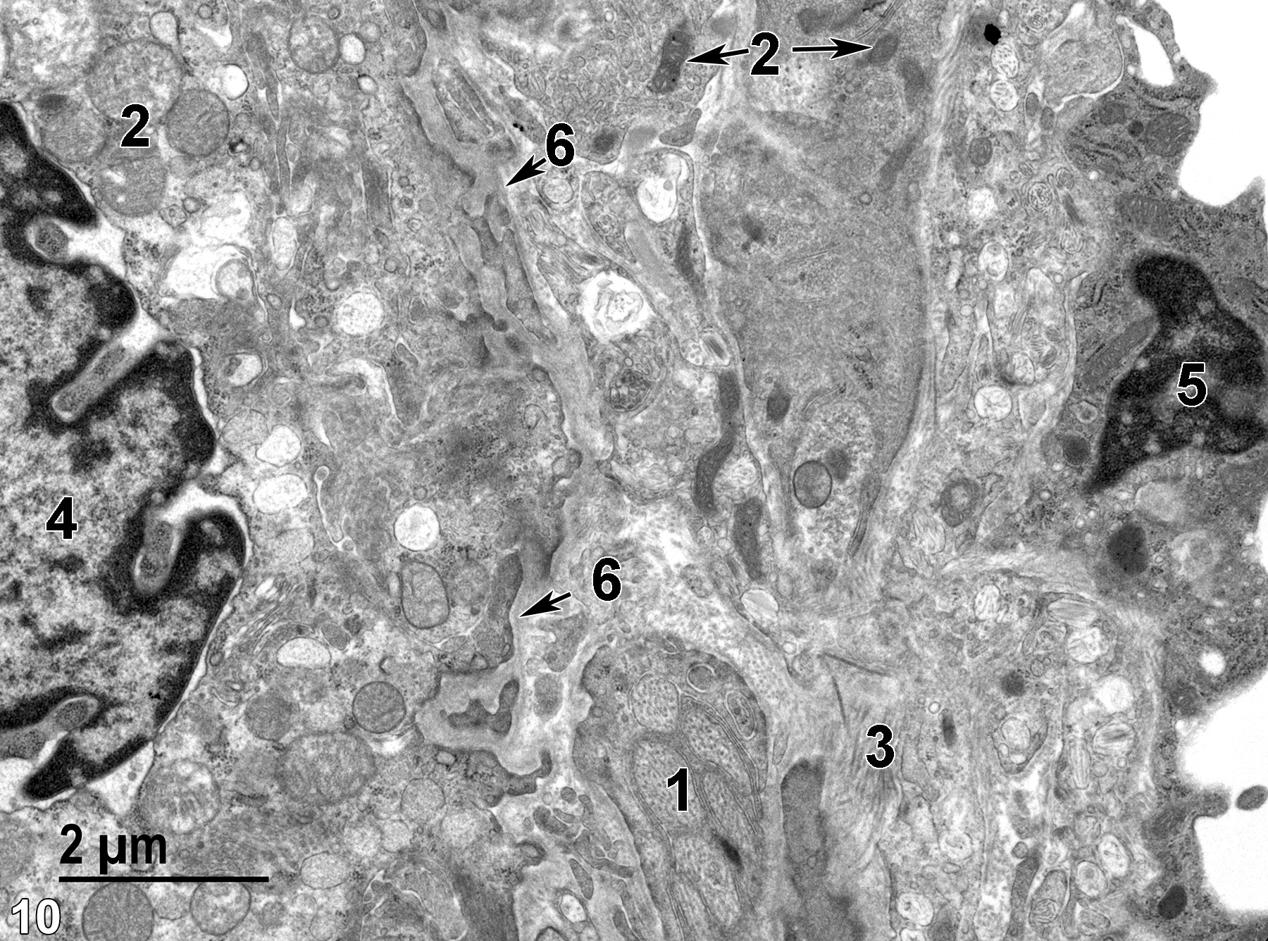 <strong>Figure 10.</strong> A higher magnification view of the stromal area of the ciliary process in the right half of the image with neural processes containing microtubules (1) and collagen bundles (3) produced by fibroblasts (5). An epithelial cell that has a nucleus (4) with irregular borders and marginated heterochromatin is separated from the stromal layer by a basal lamina (6, arrow). Note the difference in size, morphology, and matrical density of the mitochondria (2) of the epithelial cell versus the stromal cells (double arrows). 11000x.