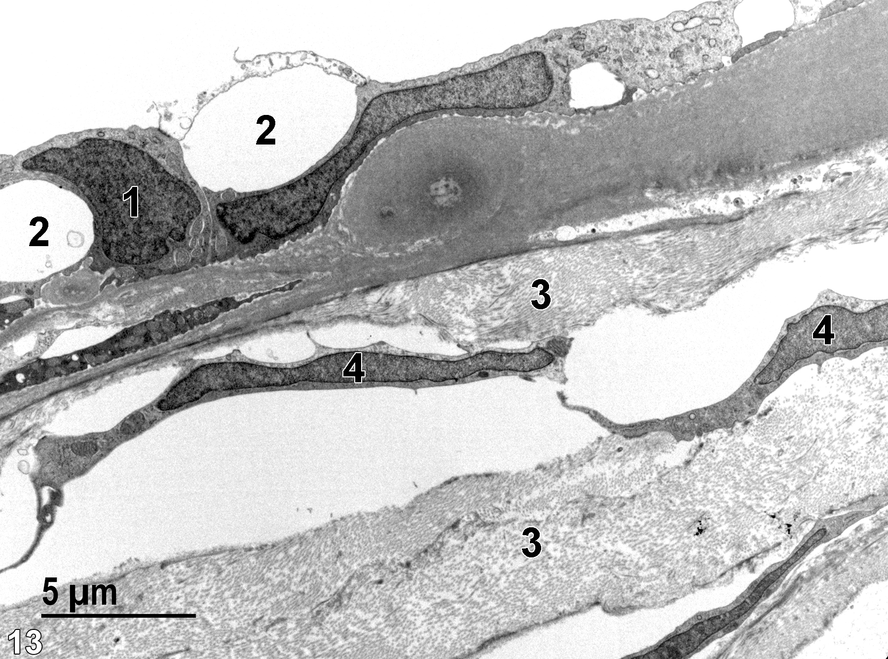 <strong>Figure 13.</strong> An even higher magnification of the trabecular meshwork. Large areas of the endothelial layer lining Schlemm’s canal often contain large vacuoles (2). The nuclei of the endothelial cells (1) are frequently pleomorphic in the vacuolated area. Note the elongated nuclei (4) in the attenuated fibroblasts and the bundles of collagen fibrils (3) comprising the beams of the trabecular meshwork. 4800x.