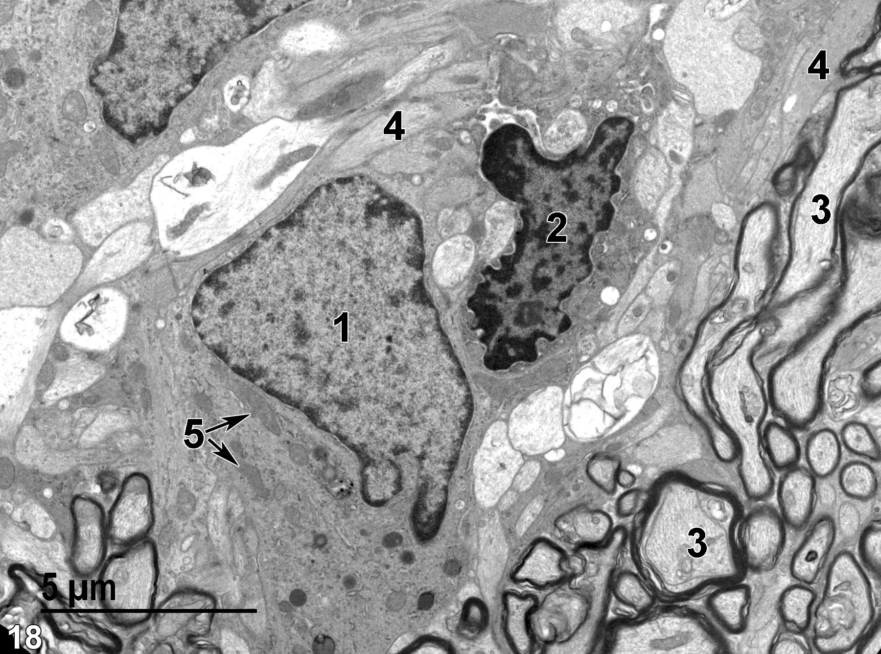 <strong>Figure 18.</strong> A probable astrocyte with a large nucleus (1) containing mostly euchromatin and a few mitochondria (5, double arrows). A cell with a polymorphic nucleus (2) with much marginated heterochromatin is consistent with a microglial cell. Myelinated axons (3) in a transverse and longitudinal section that contain mostly microtubules are present, as well as unmyelinated neuronal processes (4) that primarily contain microfilaments. 6800x.