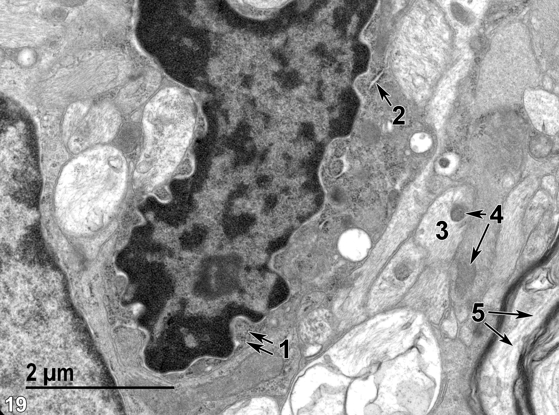 <strong>Figure 19.</strong> A higher magnification view of the glial cell shown in Figure 18, showing some polysomes (1, double arrows), along with some endoplasmic reticulum (2, arrow). An unmyelinated axon (3) contains microfilaments and microtubules, whereas the myelinated axon (5) contains mostly microtubules (double arrows). Both an unmyelinated axon and an adjacent astrocytic extension containing large amounts of microfilaments contain similar mitochondrial profiles (4, double arrows). 18500x.