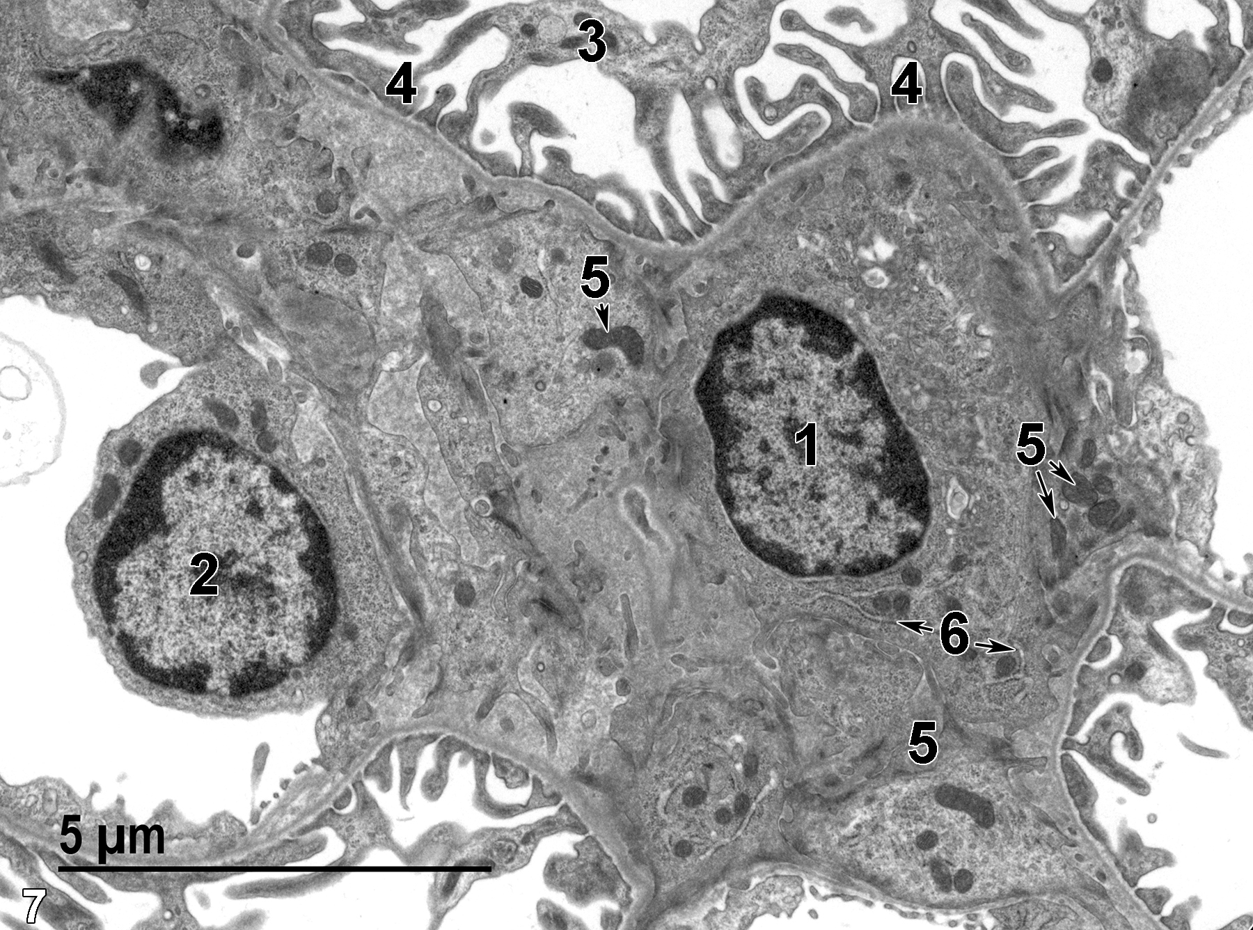 <strong>Figure 7.</strong> An enlarged view of Figure 6. The mesangial cell contains a nucleus with marginated heterochromatin (1), mitochondria (5, arrows), and rough endoplasmic reticulum (6, arrows). The nucleus (2) of a capillary endothelial cell is shown, along with pedicles (4) of a podocyte (3). Magnification not provided.