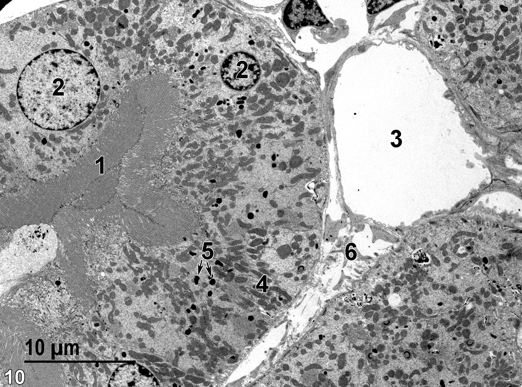 <strong>Figure 10.</strong> An image showing a proximal convoluted tubule from a kidney fixed by whole body perfusion, resulting in the collapse of the tubule lumen. The epithelial cell microvilli (1) have collapsed into the tubule lumen, occluding it. Lysosomes (5, arrows) are scattered throughout the cytoplasm, as are mitochondria (4). Epithelial cell nuclei (2) are round with prominent marginated heterochromatin. A capillary (3) is adjacent to an area of connective tissue (6). Magnification not provided.