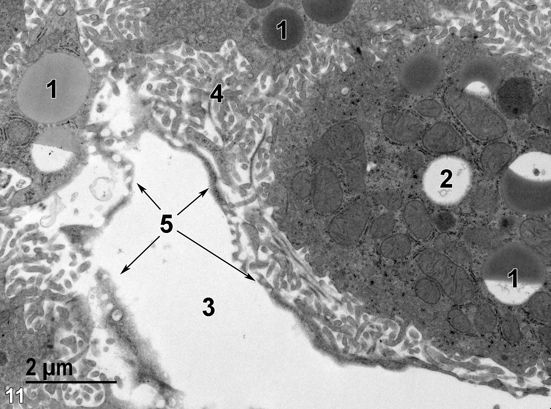 <strong>Figure 11.</strong> A higher magnification image of the Ito cell shown in Figure 10 shows the variation in lipid content and lipid staining of lipid bodies (1), including one presumed lipid body (2) that has been totally extracted. The sinusoidal lumen (3) is contained within the fenestrated endothelial cell (5, arrows). The microvilli (4) of the adjacent hepatocyte occupy the space of Disse between the hepatocyte and the Ito cell. 11000x.
