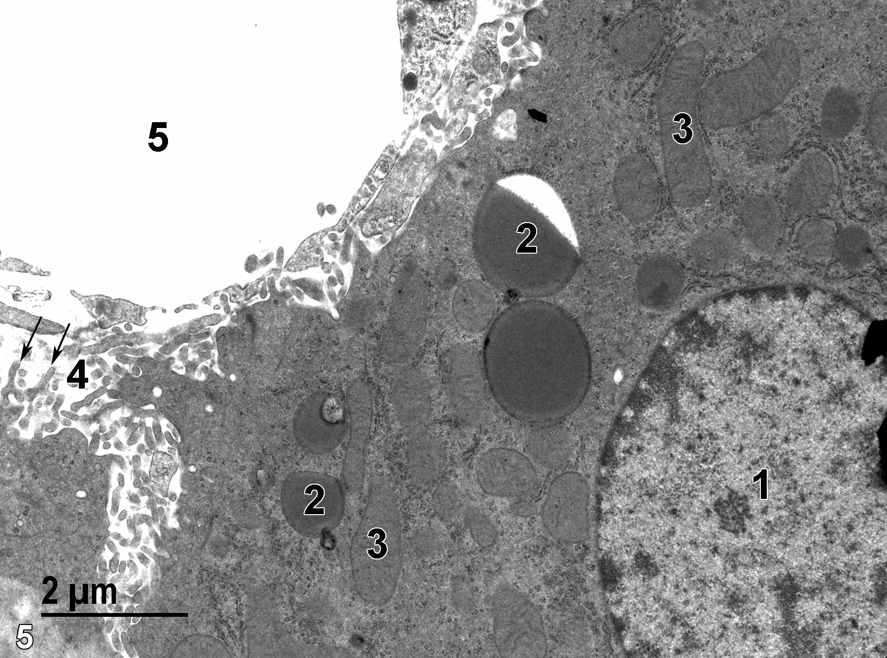 <strong>Figure 5.</strong> A sinusoidal lumen (5) with the adjacent space of Disse occupied by hepatocyte microvilli (4, arrows) shows how some of the microvilli are branched. The hepatocyte contains prominent lipid droplets (2) and mitochondria (3), in addition to the round nucleus (1) with electron-dense marginated heterochromatin. 11000x.
