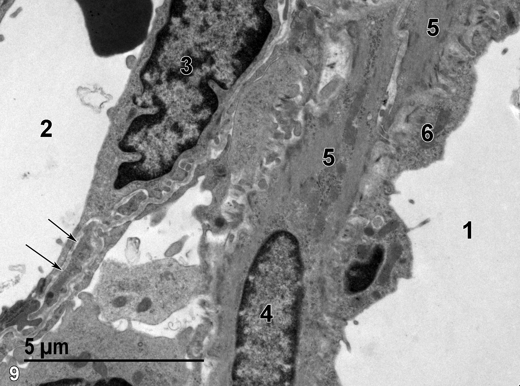 <strong>Figure 9.</strong> A higher magnification view of Figure 8 shows the portal vein lumen (2) lined by an endothelial cell (3), with an underlying basal lamina (arrows). The portal artery lumen (1) is lined with an endothelial cell layer (6) subtended by smooth muscle cells (5), one with an elongate nucleus with prominent marginated heterochromatin (4). 9300x.