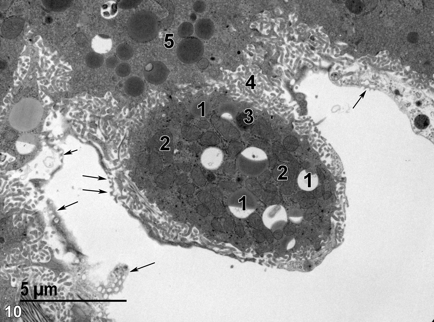 <strong>Figure 10.</strong> An Ito cell in the space of Disse with lipid droplets (1), some of which appear to be partially extracted during processing for transmission electron microscopy, as well as mitochondria (2) of various sizes and conformations. A single lysosome (3) is present. The microvillous surface (4) protruding into the space of Disse adjacent to a hepatocyte (5) is shown, along with the thin fenestrated endothelial cell lining the sinusoid (arrows). 6800x.