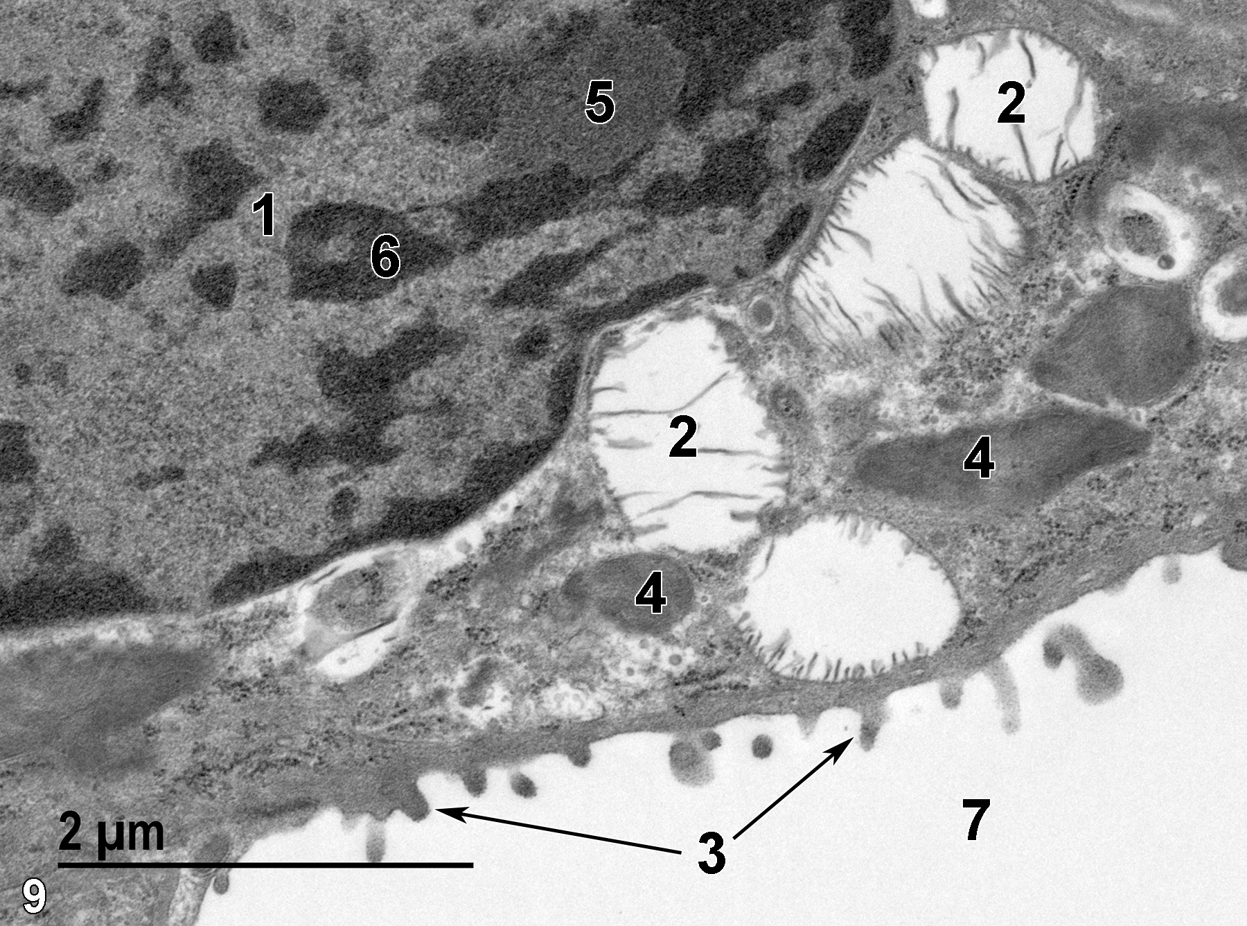 <strong>Figure 9.</strong> A high magnification view of a type II cell showing a nucleus (1) with a nucleolus (5) and scattered electron-dense heterochromatin (6). The surface of the type II cell in contact with the alveolar airway (7) has short microvilli (3, arrows). Mitochondria (4) and multilamellar bodies (2) containing surfactant are present. 23000x.