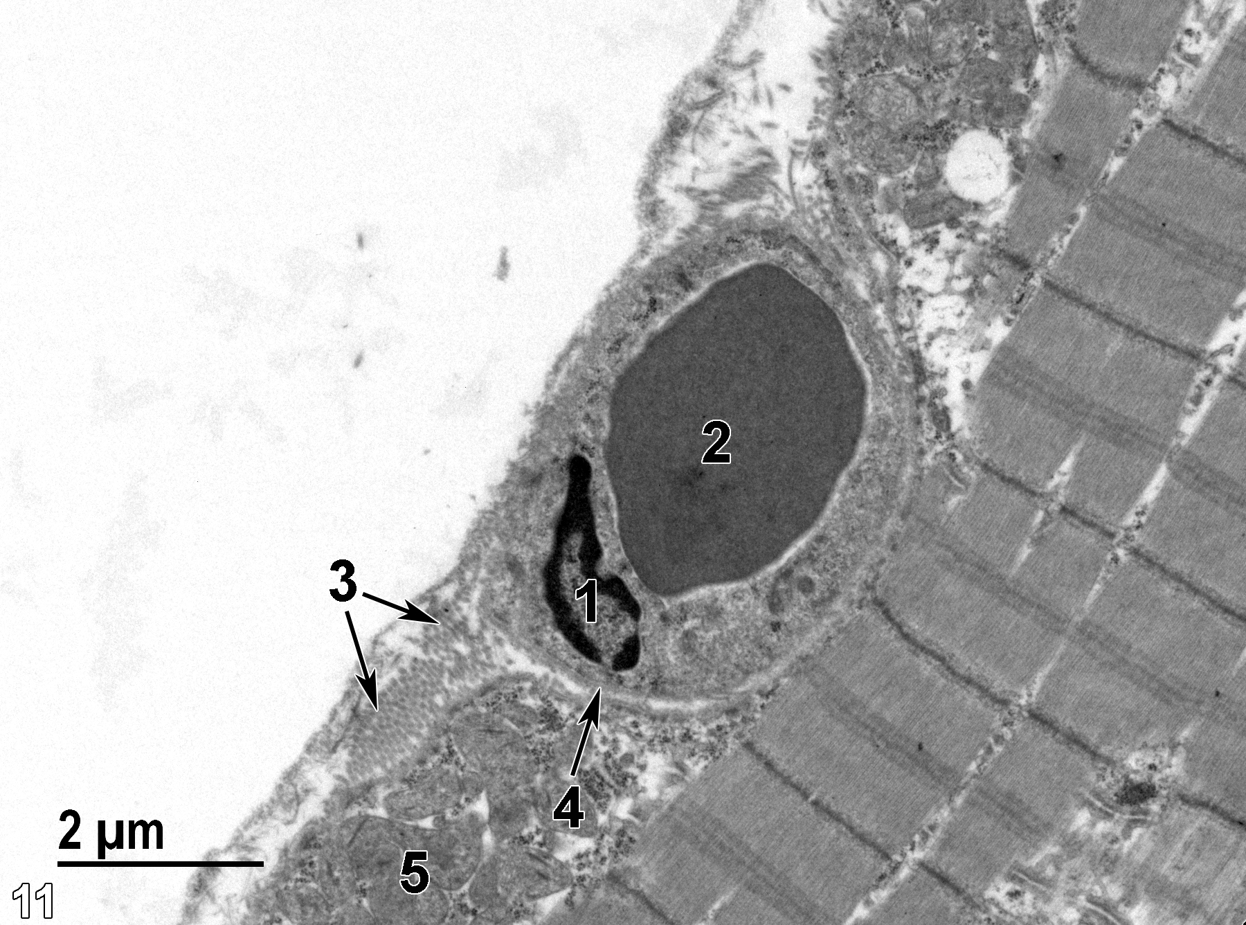 <strong>Figure 11.</strong> An ultrastructural image showing an endothelial nucleus (1) of a capillary containing an erythrocyte (2). The capillary is surrounded by a basal lamina (4, arrow). Clusters of collagen (3, double arrows) are evident. A group of mitochondria (5) is located at the periphery of the myocyte cytoplasm. 11000x.