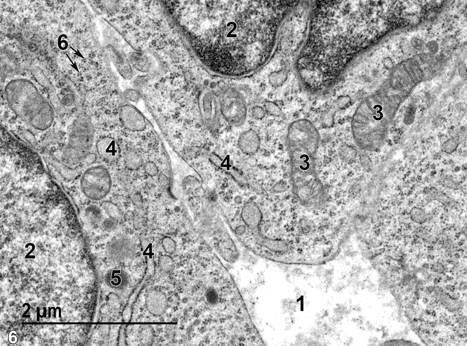 <strong>Figure 6.</strong> An even higher magnification of follicular cells with interstitial liquor folliculi (1), nuclei (2) with evident nuclear envelopes, mitochondria (3) with a rough endoplasmic reticulum with ribosomes (4) on the membrane surfaces that is both tubular and vesicular in profile, a lipid droplet (5), and clusters of free ribosomes in the cytoplasm (6, arrows). 23000x.