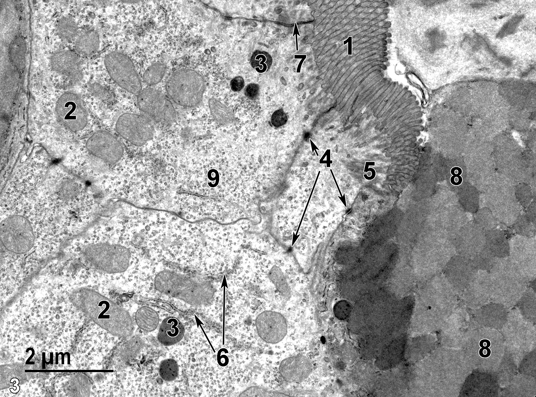 <strong>Figure 3.</strong> A high magnification view of the duodenal epithelial cells. The surface of the less electron-dense absorptive cells is covered with densely packed microvilli (1). Mitochondria (2) are pleomorphic. A number of small lysosomes (3) are present, along with desmosomes (4, arrows) and other elements of junctional complexes (7, arrow) binding epithelial cells to each other. Rootlets of the terminal web (5) can be seen below the microvilli. Elements of rough endoplasmic reticulum (6, double arrows) and numerous polyribosomes (9) are present. The adjacent mucous cell is more electron-dense because of the closely packed mucous granules (8). 11000x.