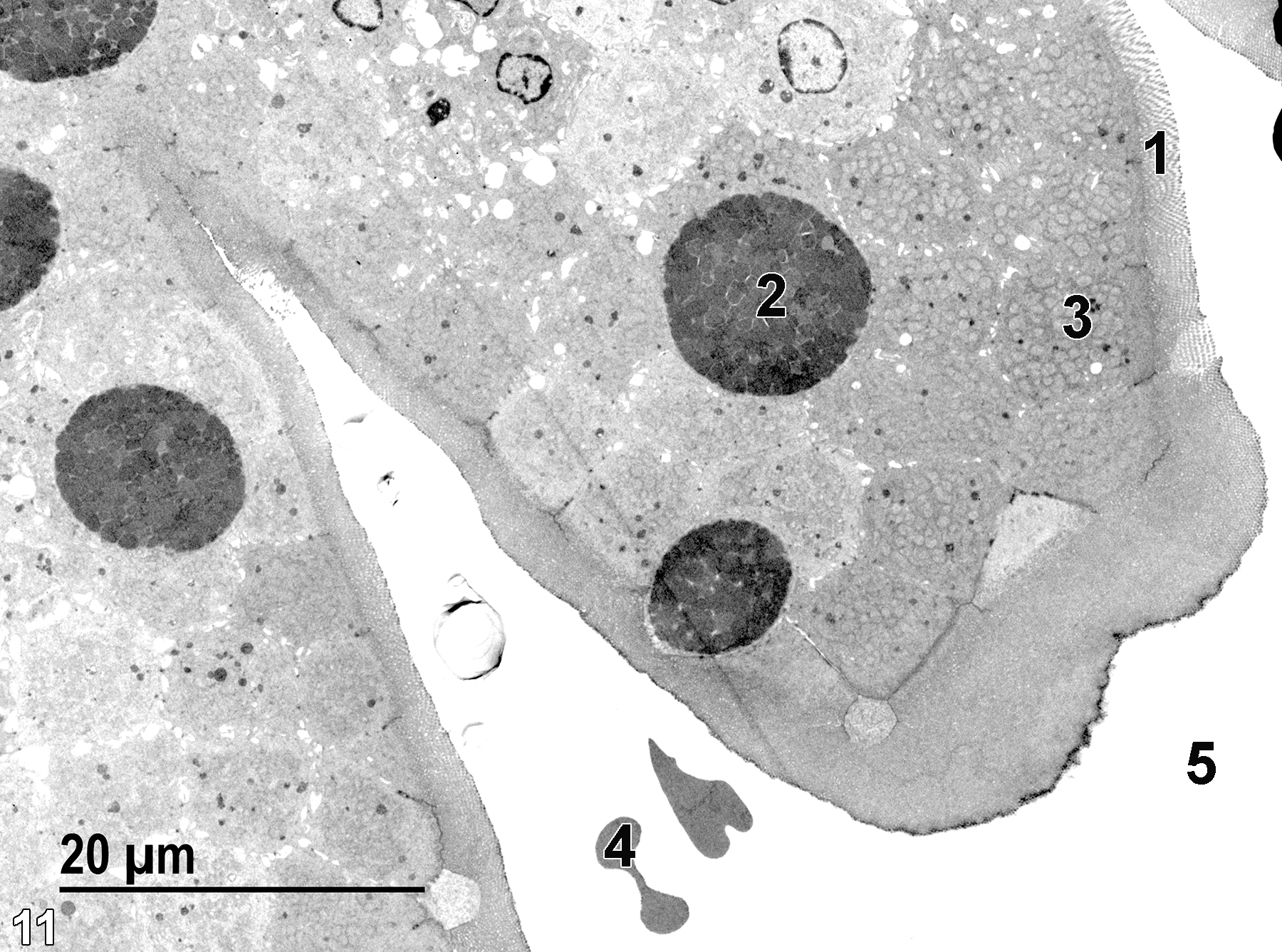 <strong>Figure 11.</strong> The tips of two villi, covered with microvilli (1). Intermixed with the absorptive epithelial cells (3) are mucous cells (2) with more electron-dense content, primarily mucous droplets. The intestinal lumen (5) contains a few erythrocytes (4), probably introduced during sample collection. 1900x.