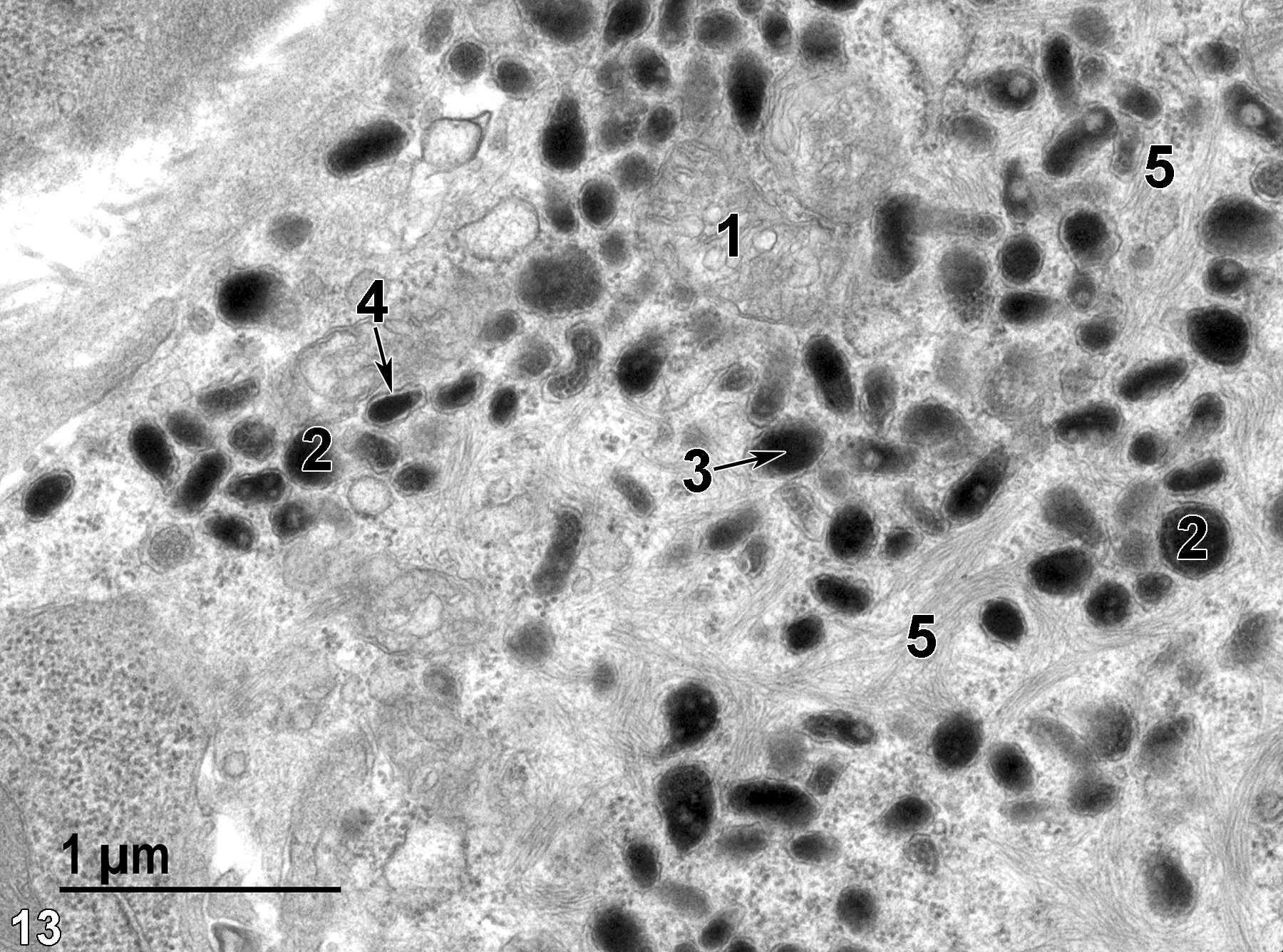 <strong>Figure 13.</strong> A high magnification view of an enteroendocrine cell. A mitochondrion (1) is surrounded by secretory granules (2) that vary somewhat in size and shape. The electron-dense core (3, arrow) is frequently separated from the membrane surrounding the granule (4). The cell also contains bundles of tonofilaments (5). 30000x.