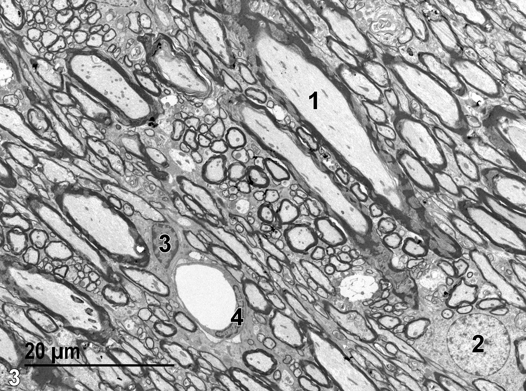 <strong>Figure 3.</strong> An electron micrograph of a longitudinal section of white matter showing a myelinated axon (1) with a number of electron-dense mitochondria and fibrillar material (microfilaments) in the axon cytoplasm. A single capillary (4) with an elongated endothelial nucleus is present. A large round nucleus (2) with little heterochromatin and lightly stained cytoplasm is characteristic of a perikaryon of a neuron. The smaller nucleus (3) with more marginated heterochromatin is consistent with an astrocyte. 1900x.