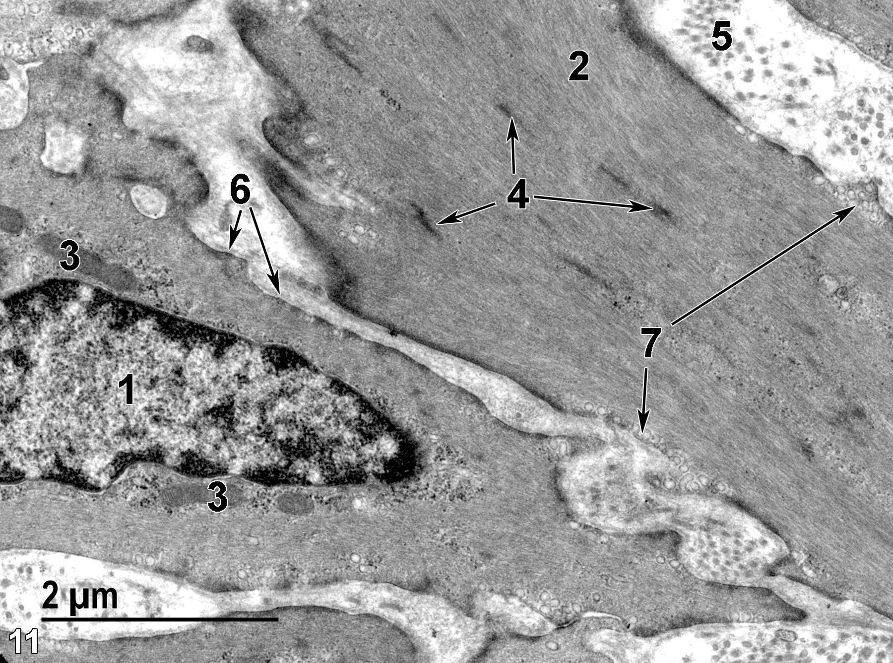 <strong>Figure 11.</strong> A higher magnification view of the smooth muscle cells of the muscularis mucosae. Each cell contains a single nucleus (1), a small number of mitochondria (3), large quantities of cytoplasmic protein fibrils (2) composed of actin and myosin, and more electron-dense patches consistent with alpha-actinin (4, arrows). Each cell is surrounded by a basal lamina (6, arrows). The surface of the smooth muscle cells exhibits numerous micro-pinocytotic vesicles (7, arrows). The extracellular spaces contain collagen fibrils (5). 18500x.