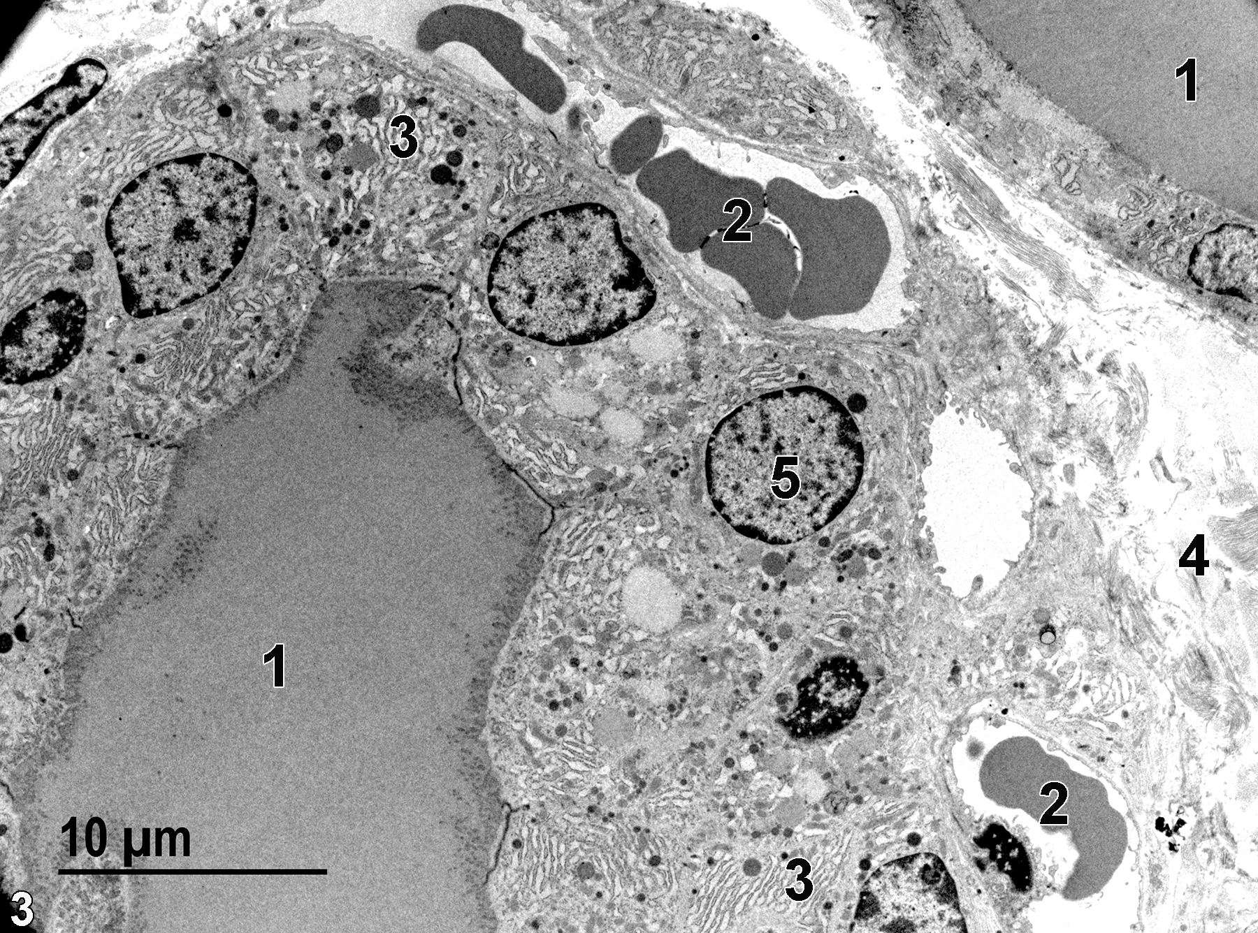 <strong>Figure 3.</strong> Another view of a follicle containing colloid (1). The follicle has capillaries (2) with erythrocytes located at the base of the epithelial cells. The epithelial cells have spherical nuclei (5) and large patches of rough endoplasmic reticulum (3). A septum of connective tissue (4), made up primarily of collagen, separates adjacent thyroid lobules. 2900x.
