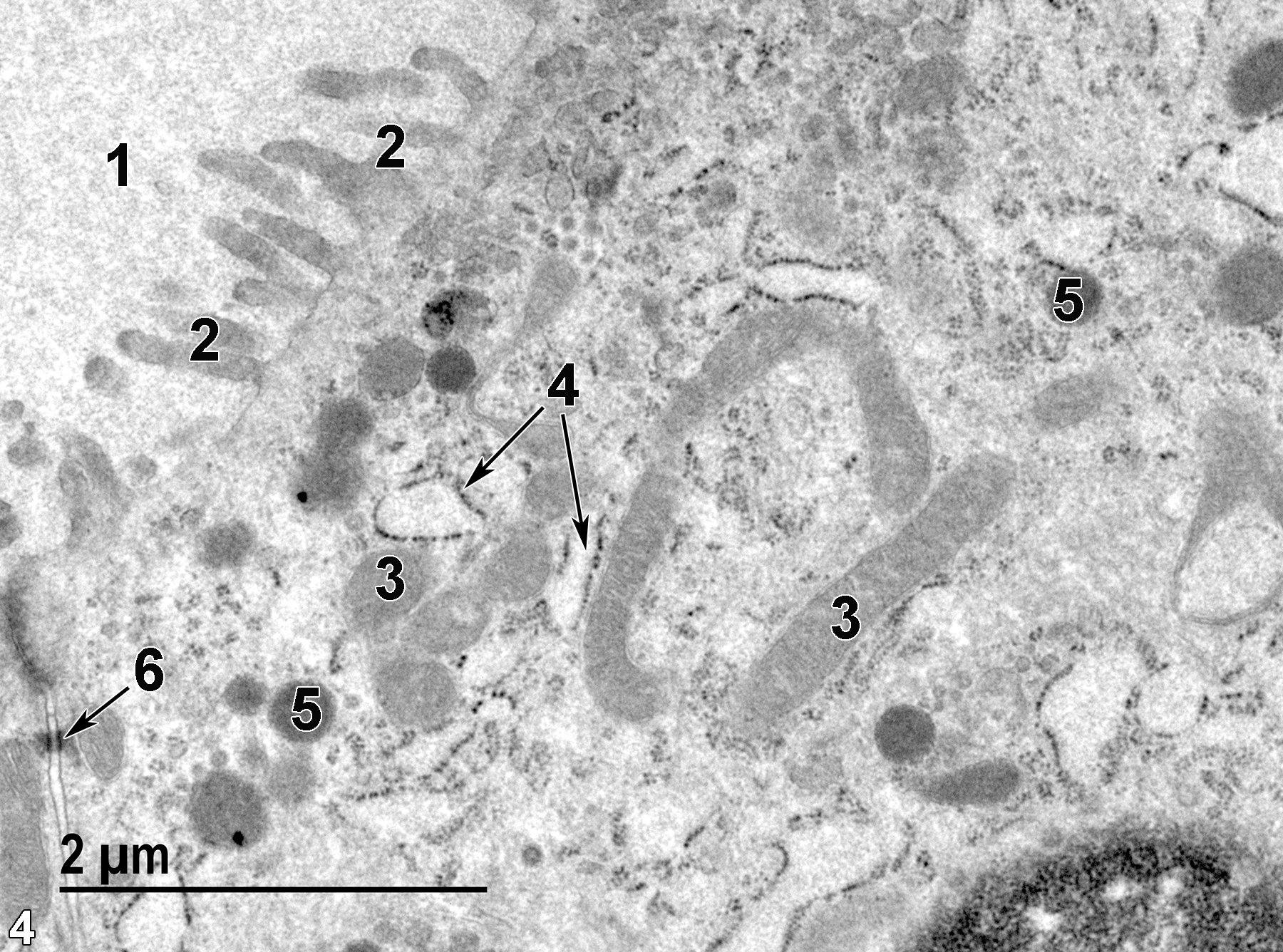 <strong>Figure 4.</strong> A high magnification view of a follicular epithelial cell. The follicular lumen (1) contains somewhat flocculent colloid. Microvilli (2) protrude into the follicular lumen. Inside the epithelial cell, there are elongated mitochondria (3), as well as rough endoplasmic reticulum profiles (4 arrows) and lysosomes (5). A desmosome (6, arrow) is located at the base of a junctional complex, binding the apical regions of adjacent epithelial cells together. 23000x.