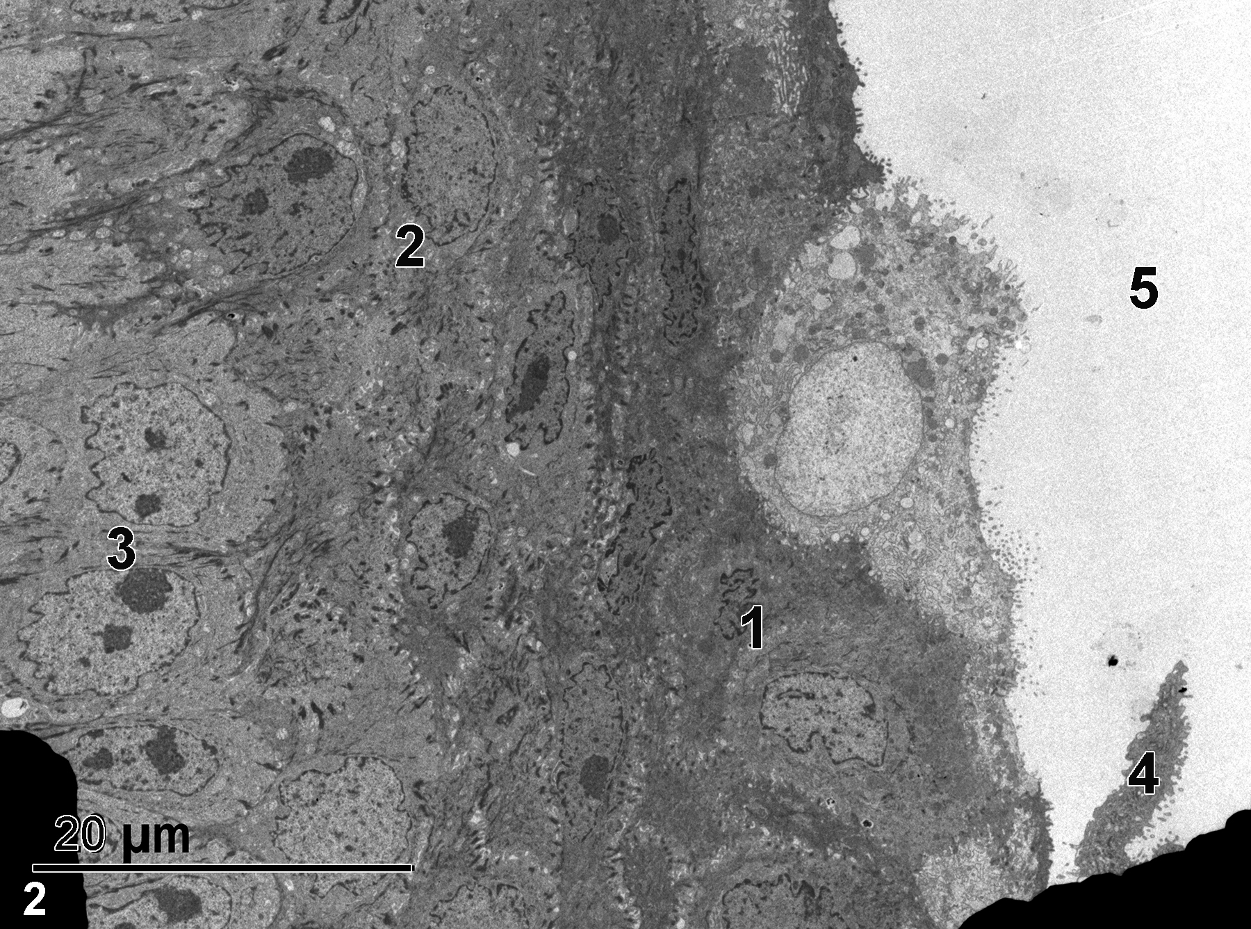 <strong>Figure 2.</strong> A low magnification view of the mucous membrane epithelial cells. The dark areas in the lower left and right of the image are grid bars. The lumen of the vagina (5) is lined with a superficial layer of stratified squamous epithelial cells (1), underlain with a layer of intermediate epithelial cells (2) that are more cuboidal, with a layer of cuboidal basal epithelial cells (3) beneath the intermediate layer. One superficial epithelial cell (4) is being shed. 1900x.