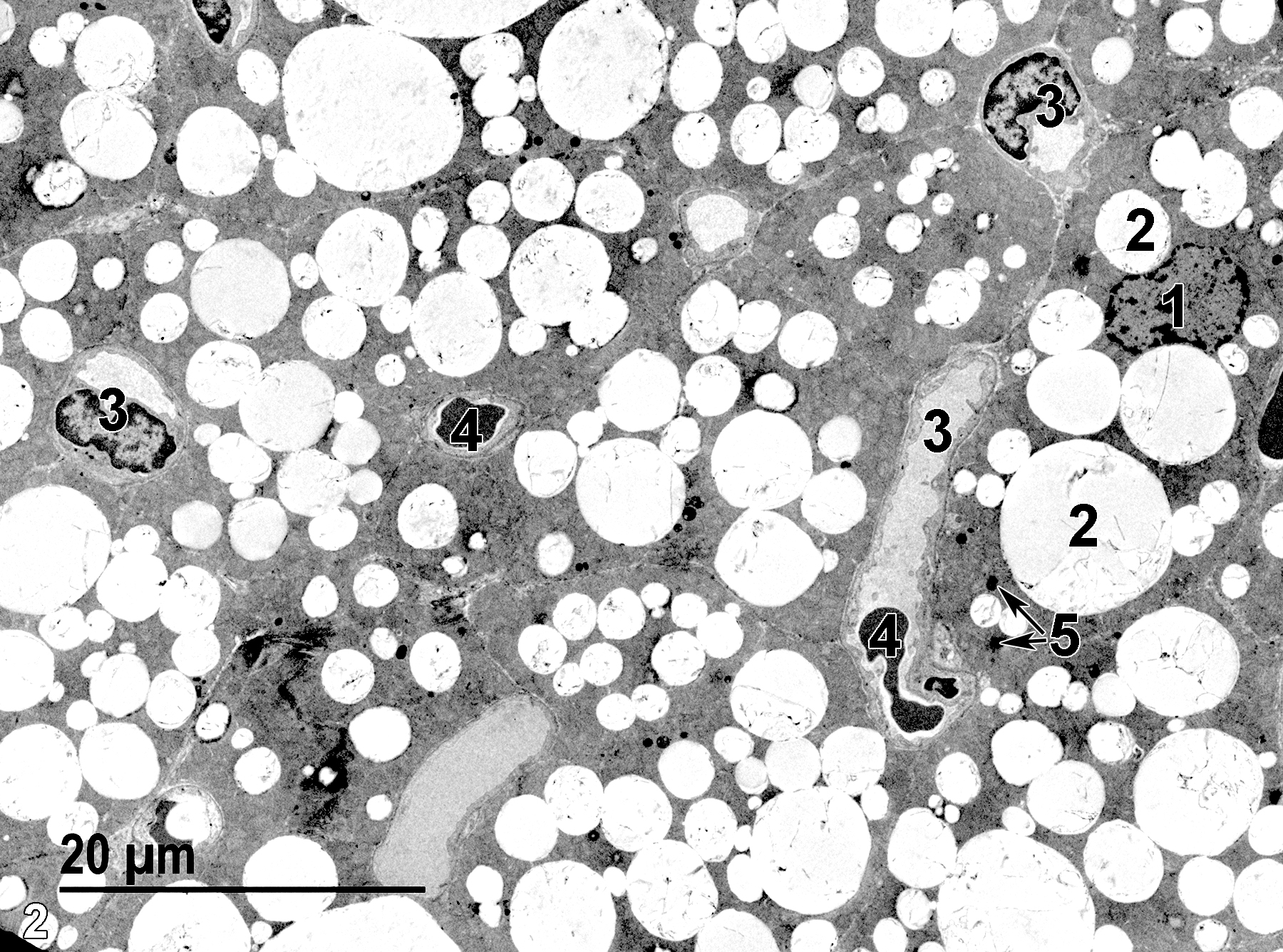 <strong>Figure 2.</strong> A low magnification ultrastructural view of the parathyroid parenchyma showing a nucleus of a chief cell (1), a large number of variably sized lipid bodies (2) within chief cells, and a number of septal capillaries (3), some containing erythrocytes (4). Low numbers of lysosomes (5) are present in the chief cells. 1900x.
