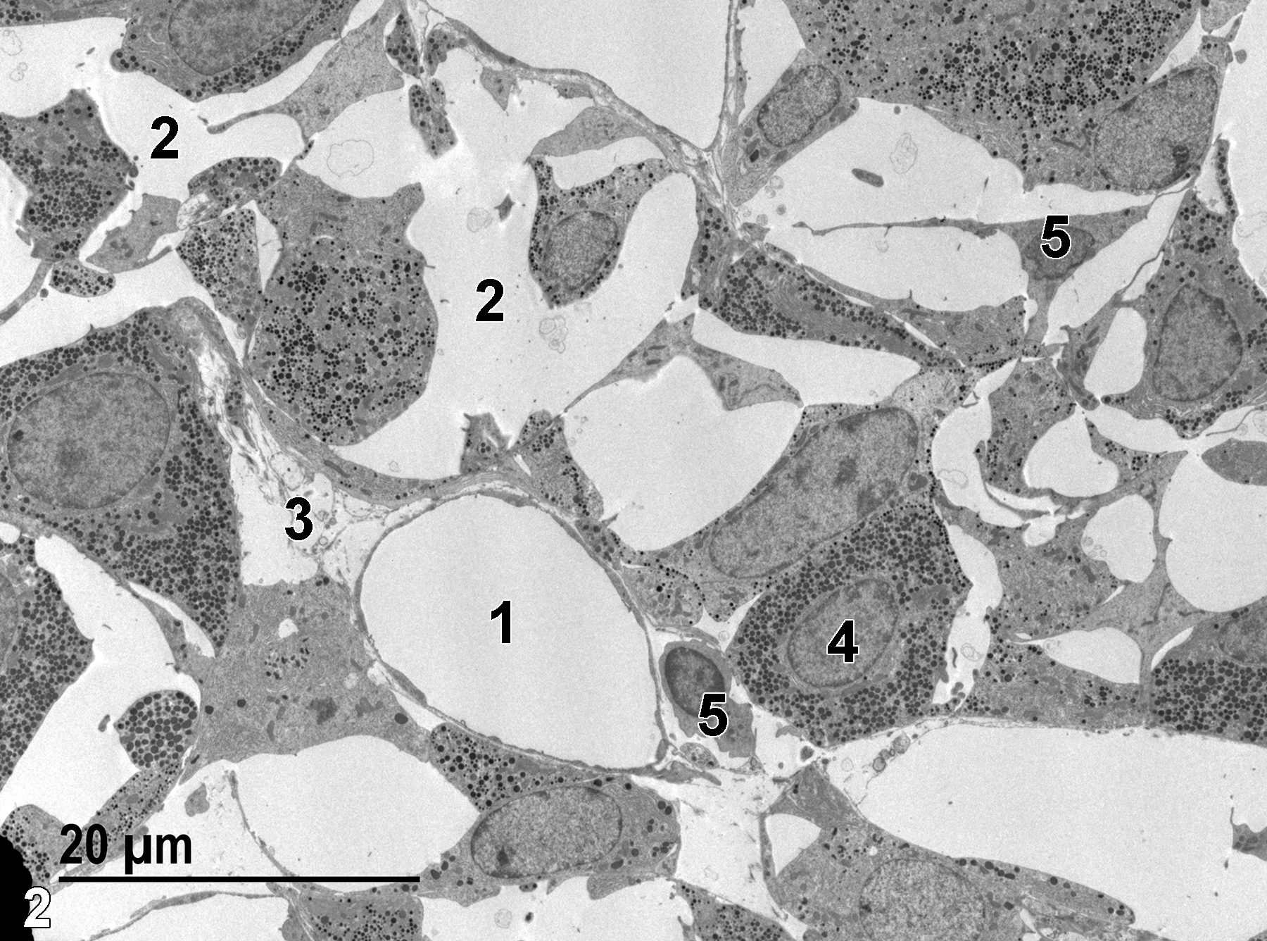<strong>Figure 2.</strong> A low-power electron micrograph of a capillary lined with a thin endothelium (1), intercellular spaces (2), an intercordal space (3) with connective tissue elements, a somatotroph cell with a single nucleus (4), and numerous secretory granules of similar sizes. Two precursor cells (5) with scant cytoplasm and rare secretory granules are present. 1900x.