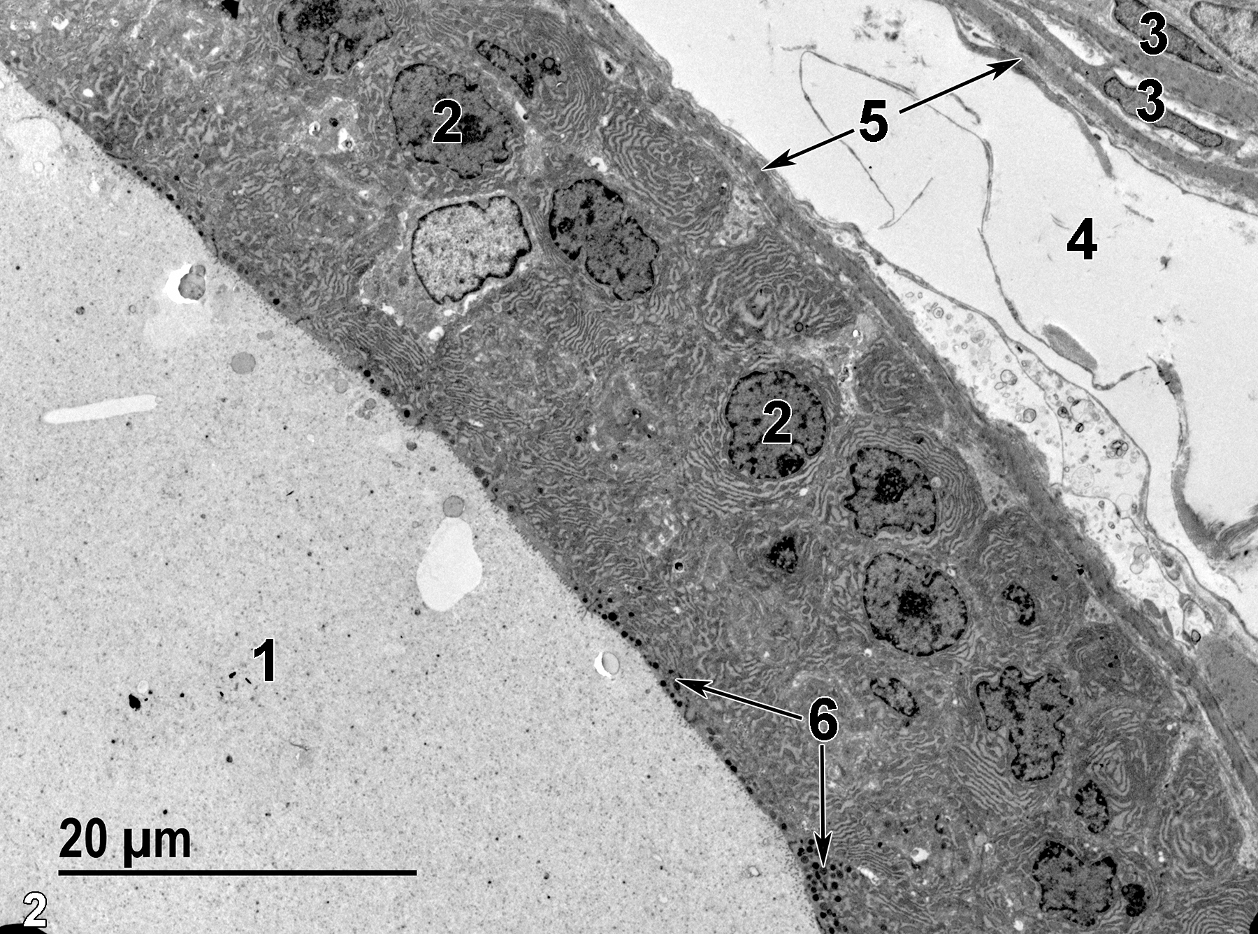 <strong>Figure 2.</strong> A low magnification ultrastructural view of a dorsolateral prostatic alveolus (1) with finely granular secretory material in the alveolar lumen. The epithelial cells have basal nuclei (2) and apical secretory granules (6, arrows). Smooth muscle cells (5, arrows) surround the basal exterior of the alveolar epithelial cells. Note the elongated and flattened nuclei (3) of the smooth muscle cells in the upper right of the image. Connective tissue (4) lies between two adjacent alveoli. 1900x.