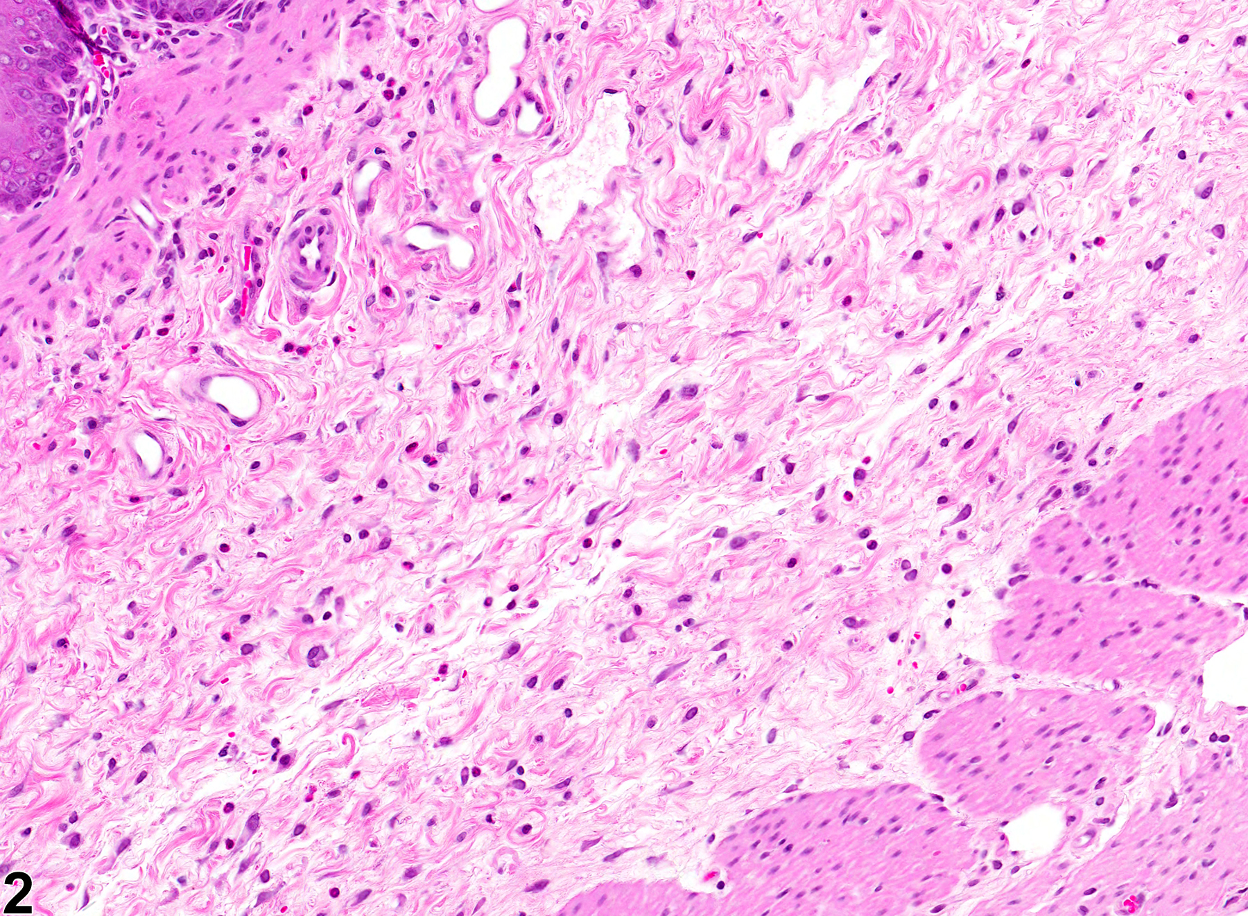 Image of fibrosis in the forestomach from a female F344/N rat in a chronic study