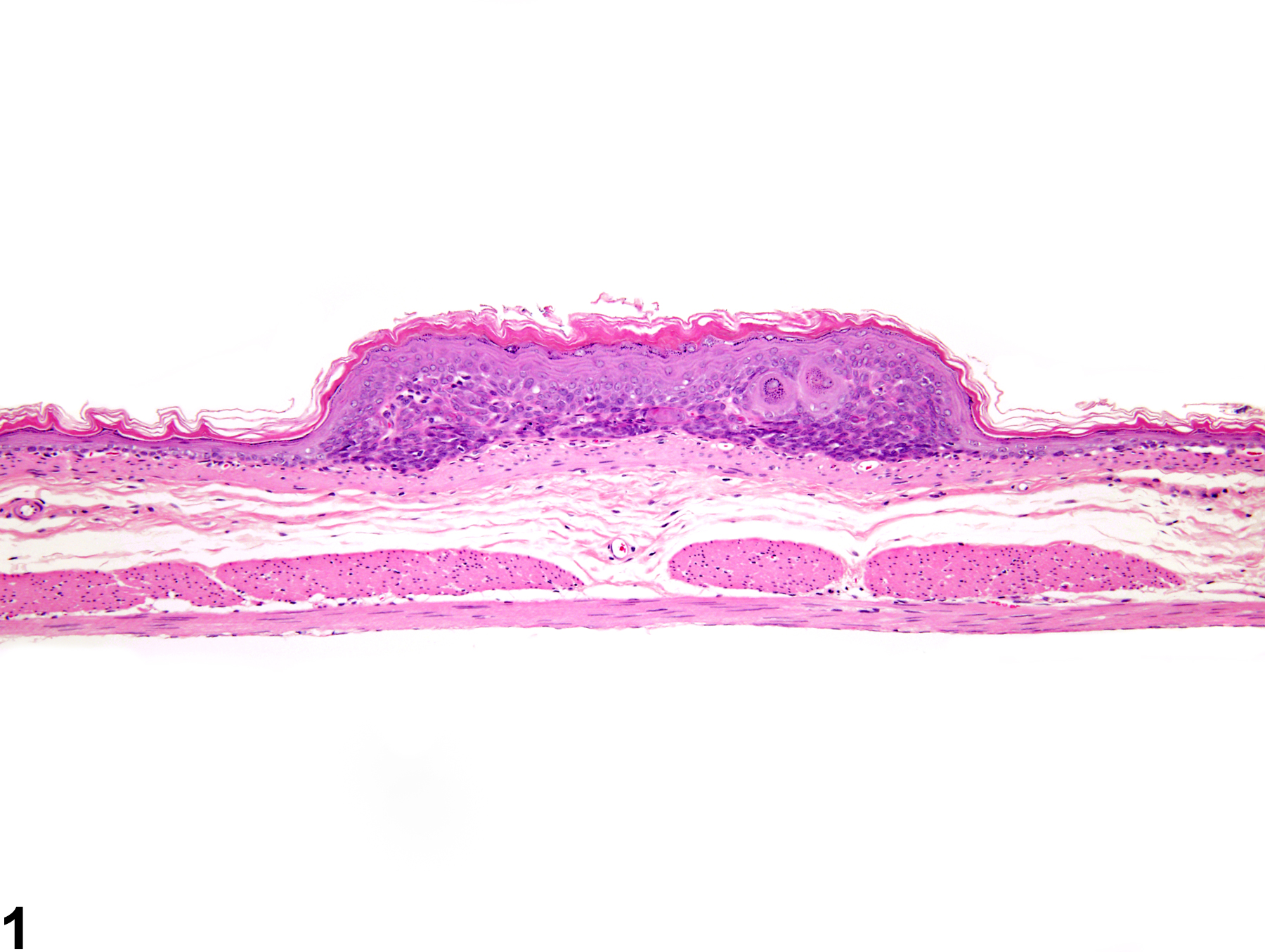 Image of hyperplasia, atypical in the forestomach epithelium from a female F344/N rat in a subchronic study