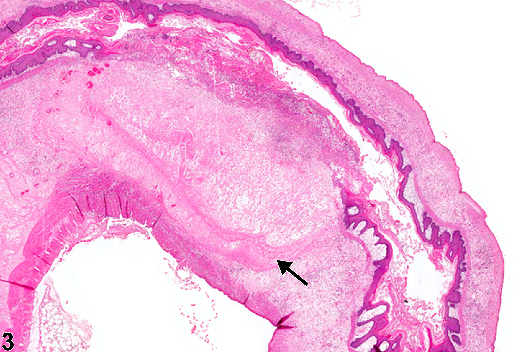 Image of necrosis in the forestomach from a male F344/N rat in a chronic study