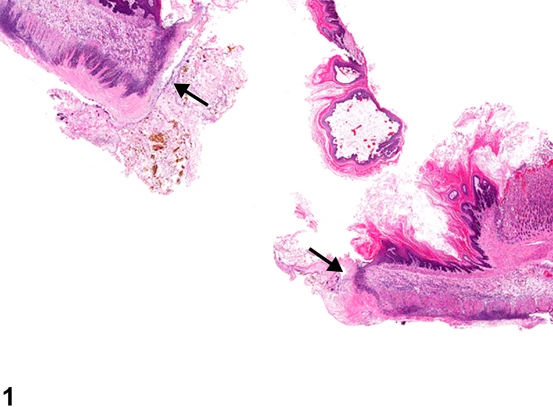 Image of perforation in the forestomach from a male F344/N rat in a chronic study