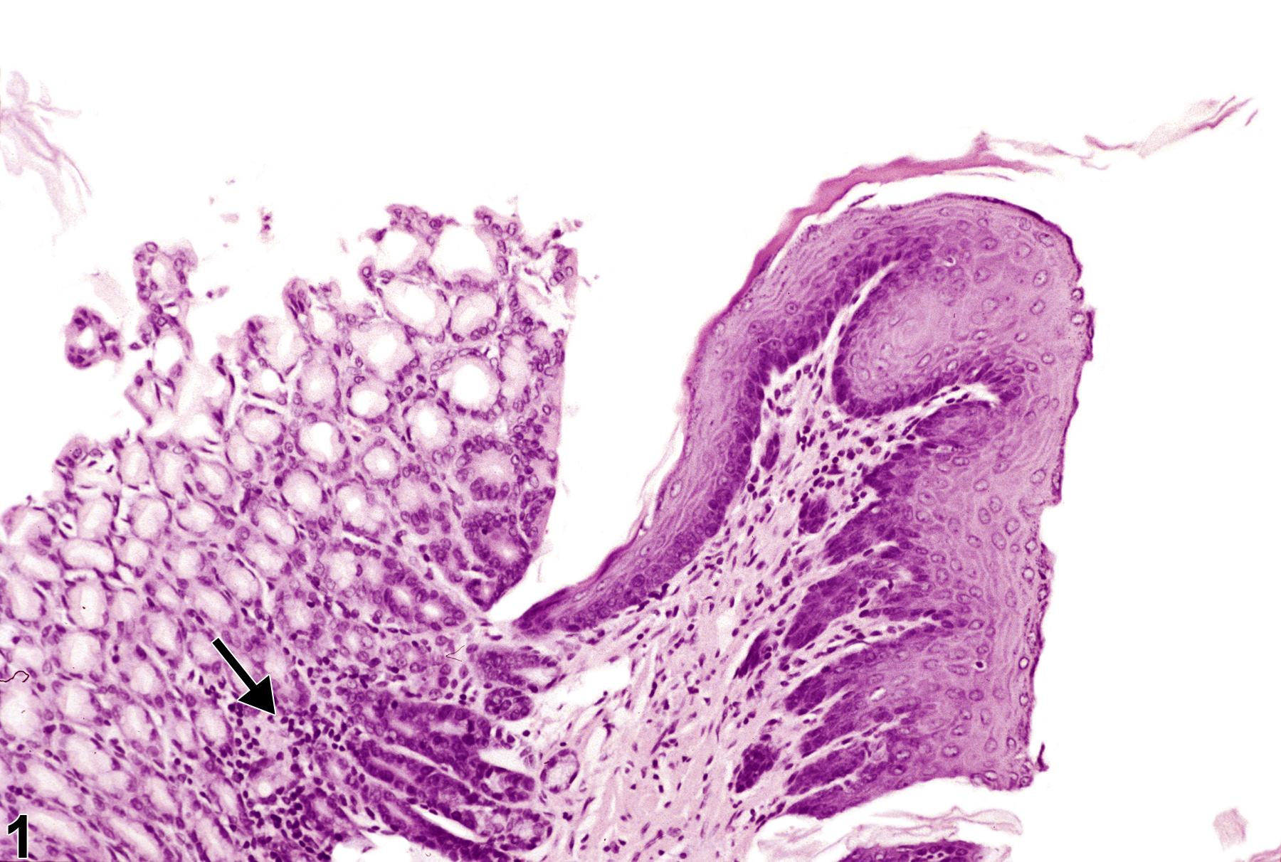 Image of infiltration cellular  in the glandular stomach from a male F344/N rat in a chronic study