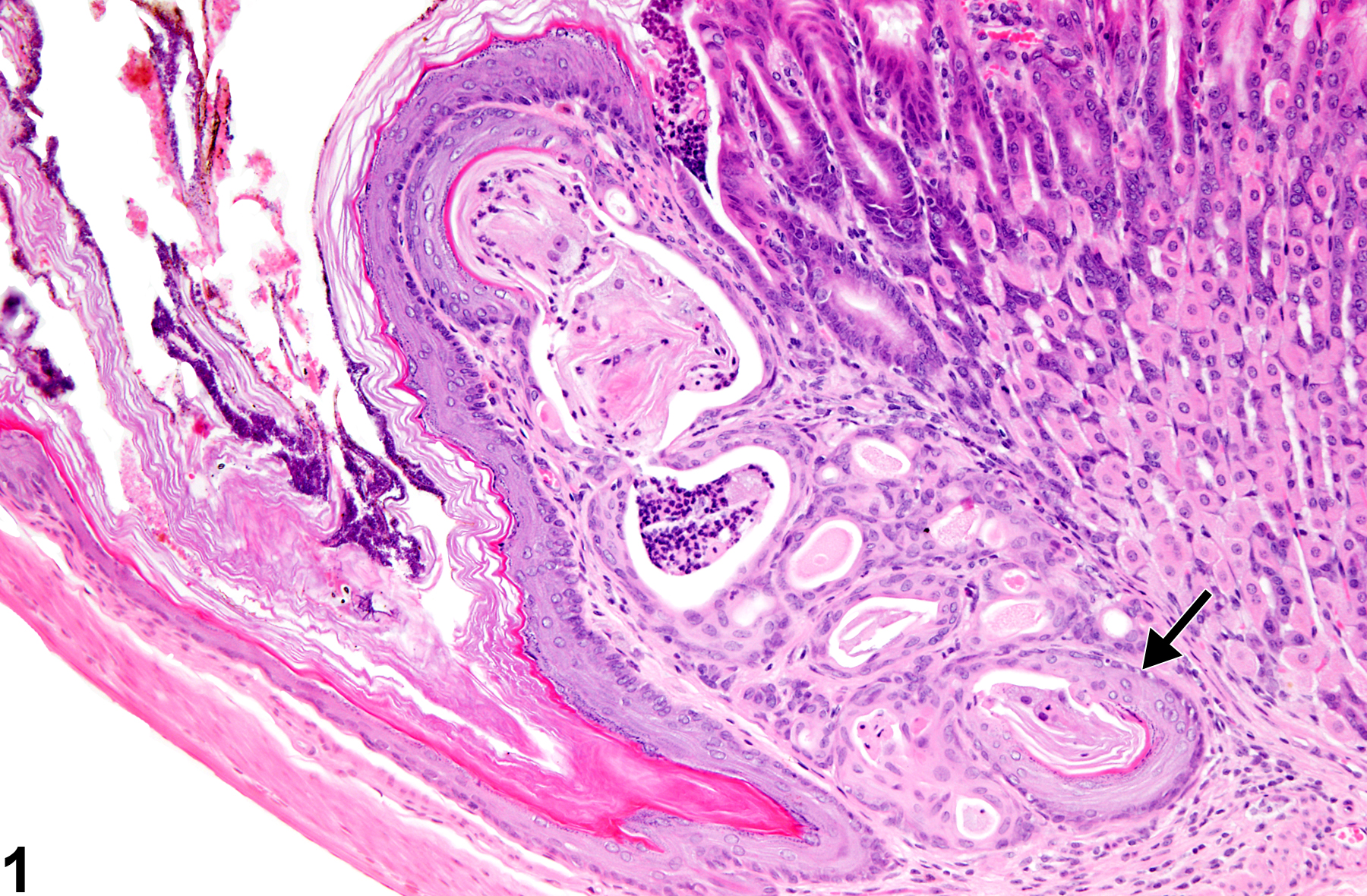 Image of metaplasia, squamous in the glandular stomach from a male B6C3F1 mouse in a chronic study