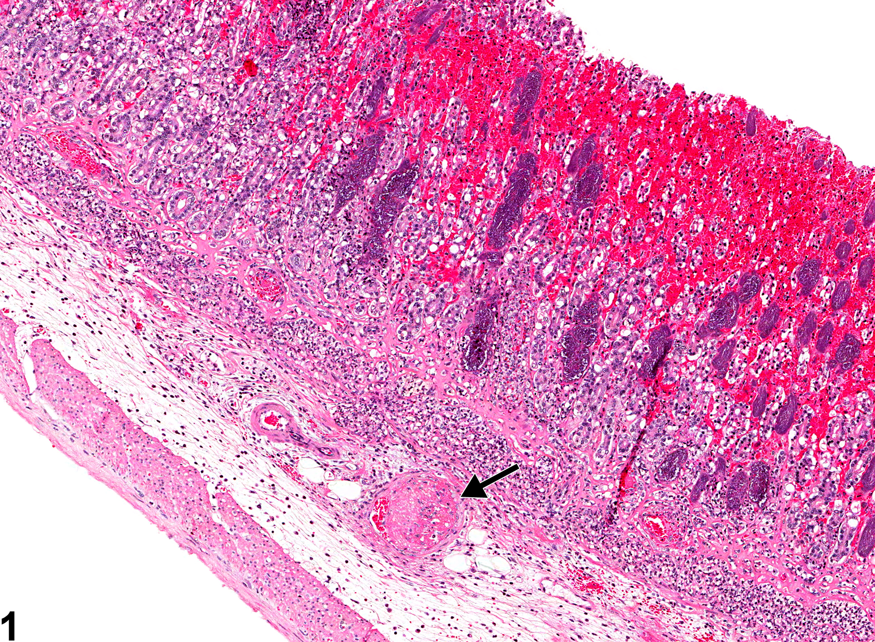 Image of thrombus in the glandular stomach from a male F344/N rat in a chronic study
