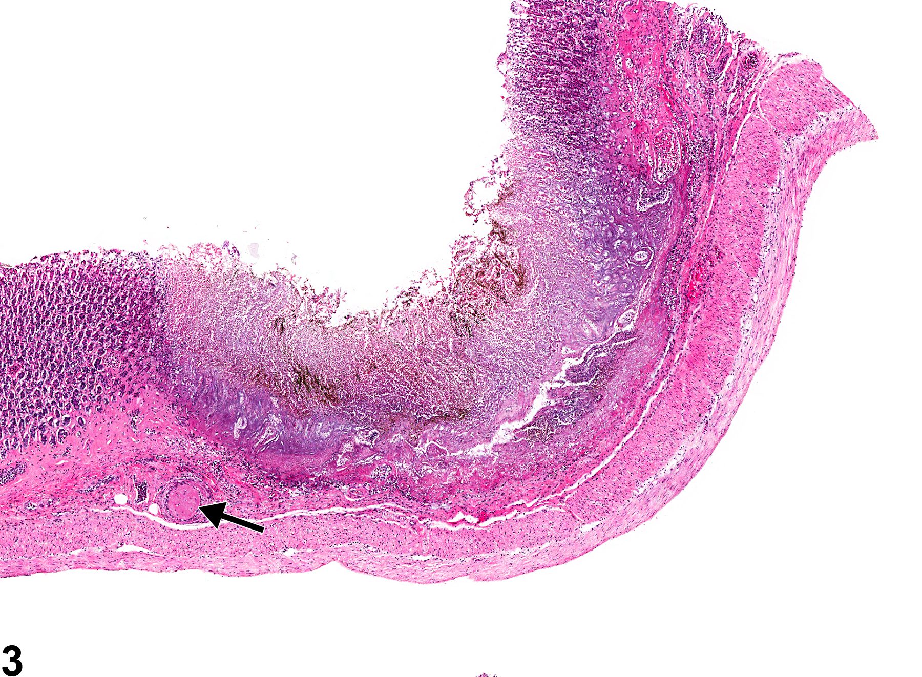 Image of thrombus in the glandular stomach from a male F344/N rat in a chronic study