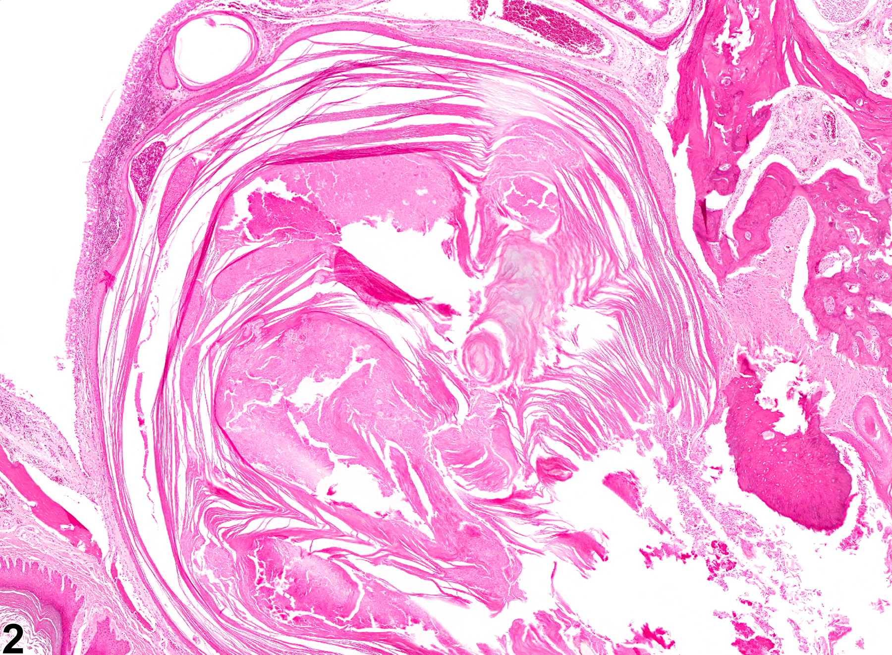 Image of hyperplasia, cystic, keratinizing in the oral mucosa from a male HSD rat in a chronic study