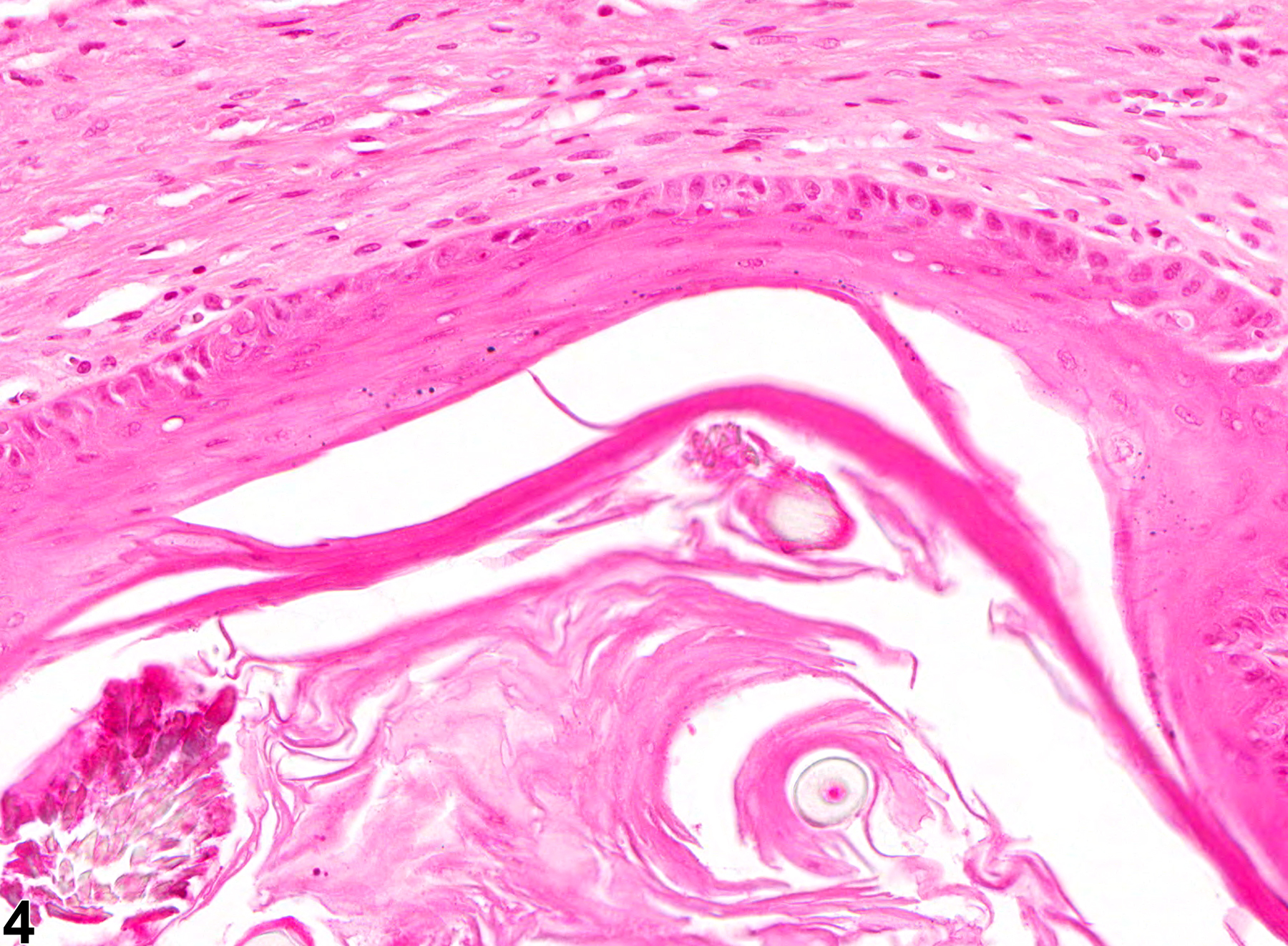 Image of hyperplasia, cystic, keratinizing in the oral mucosa from a male HSD rat in a chronic study