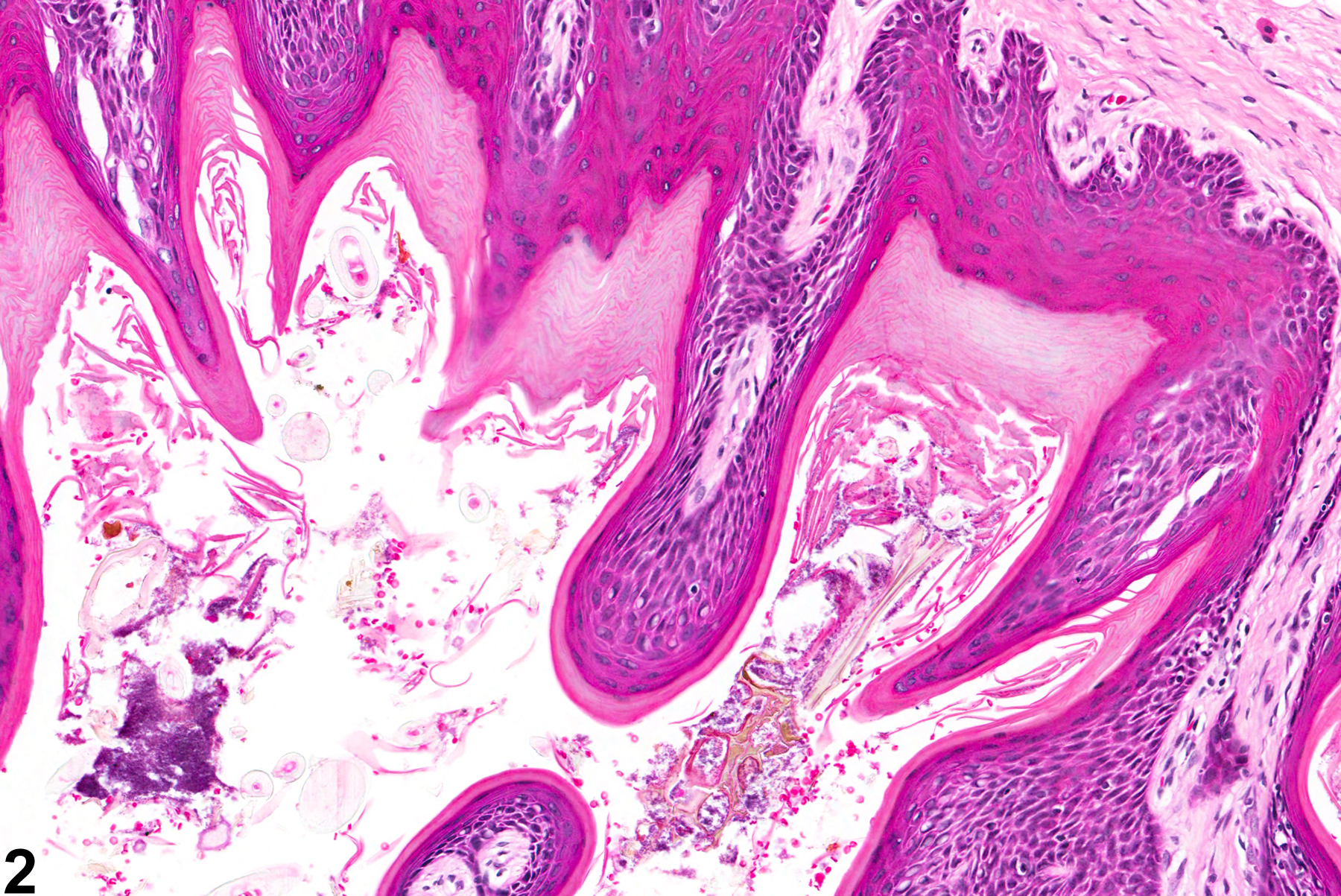 Image of hyperplasia, squamous in the oral mucosa from a female F344/N rat in a chronic study