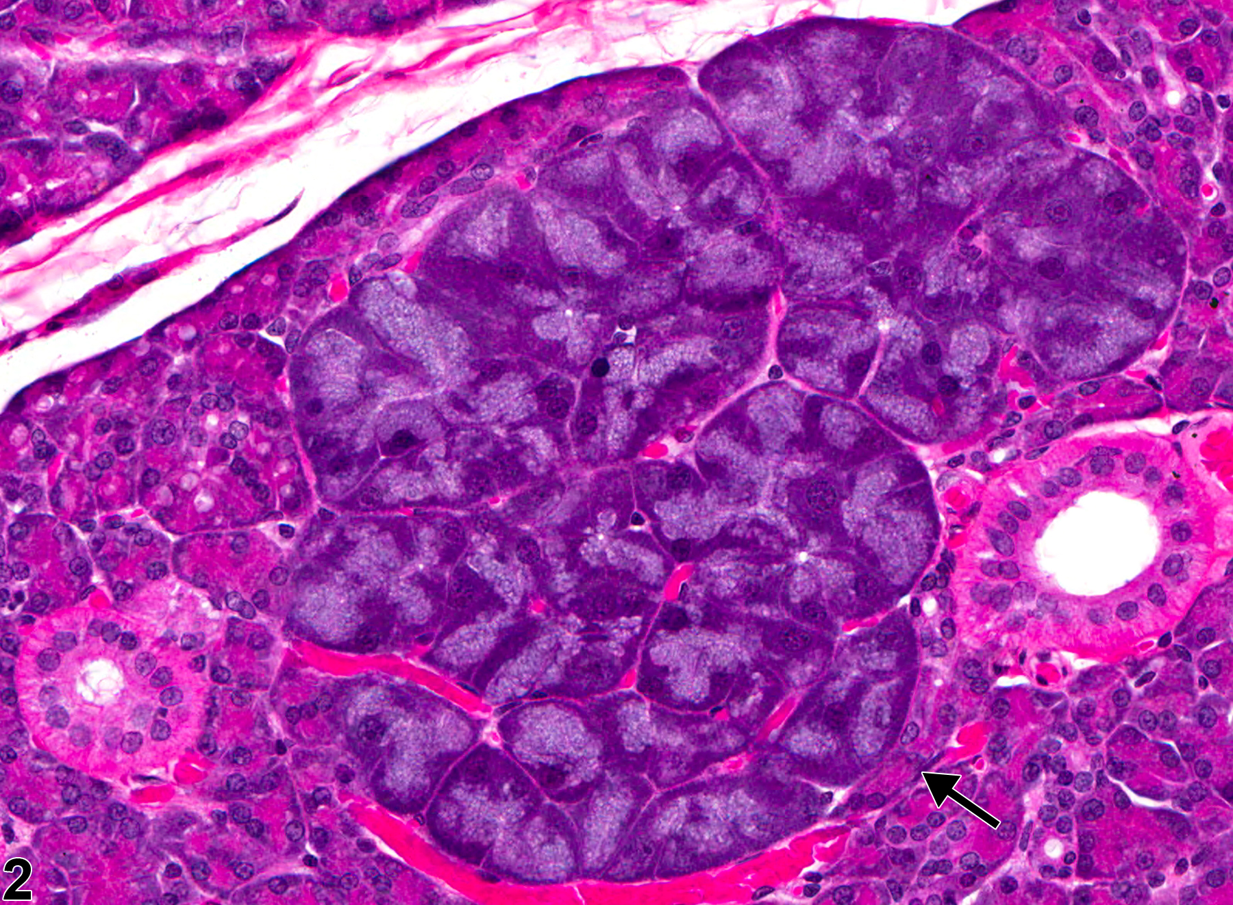 Image of basophilic hypertrophic focus in the parotid salivary gland from a female F344/N rat in a chronic study