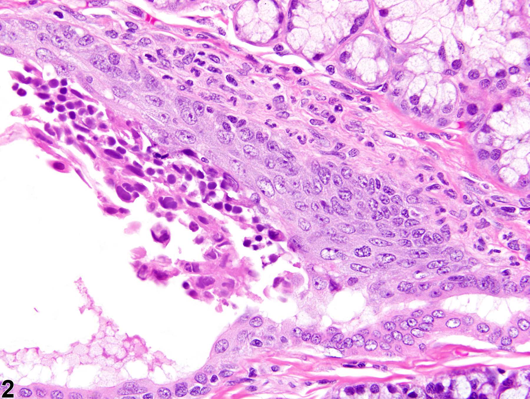 Image of metaplasia, squamous in the salivary gland duct from a male F344/N rat in a chronic study