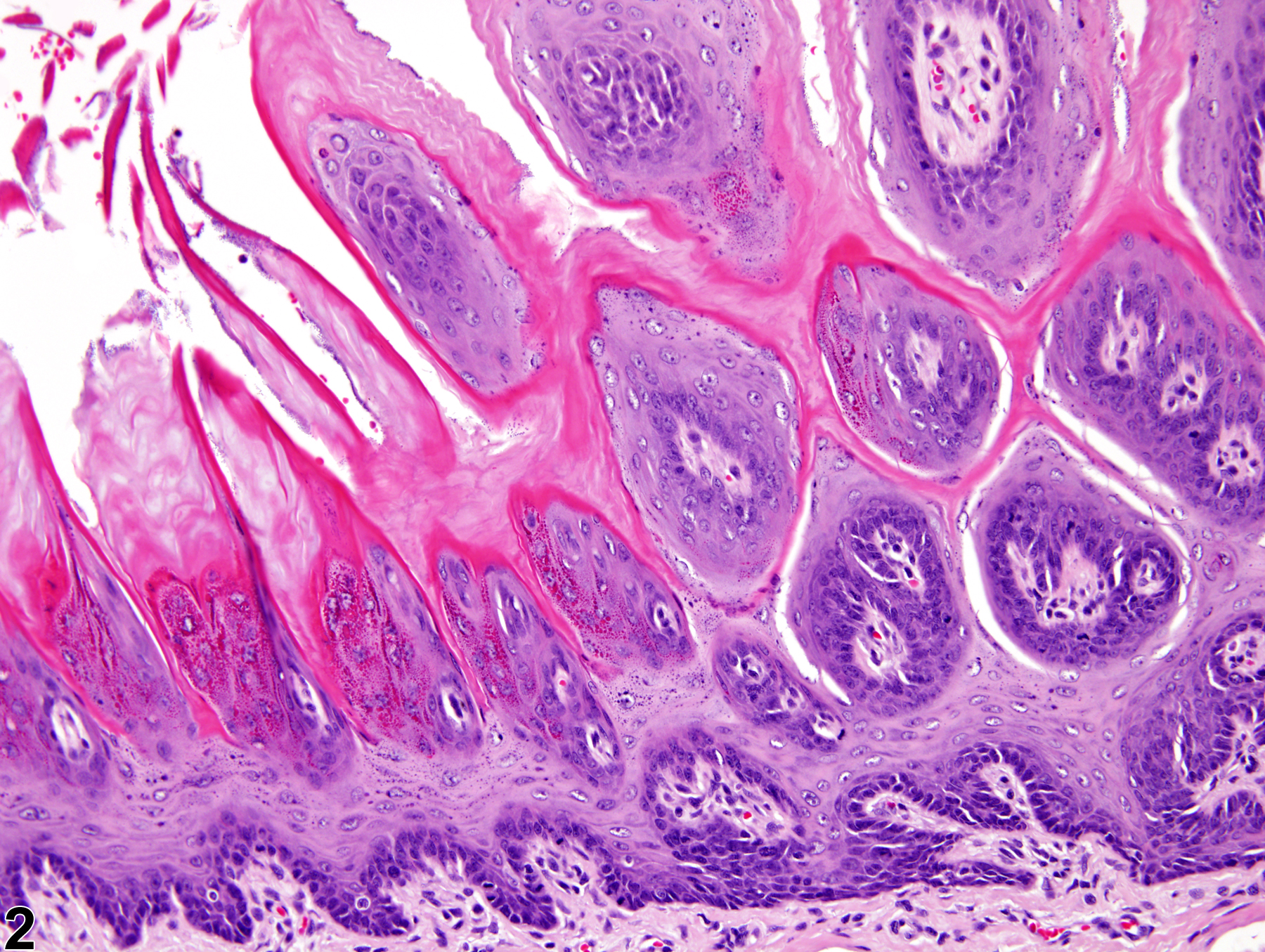 Image of hyperplasia in the tongue epithelium from a female F344/N rat in a chronic study