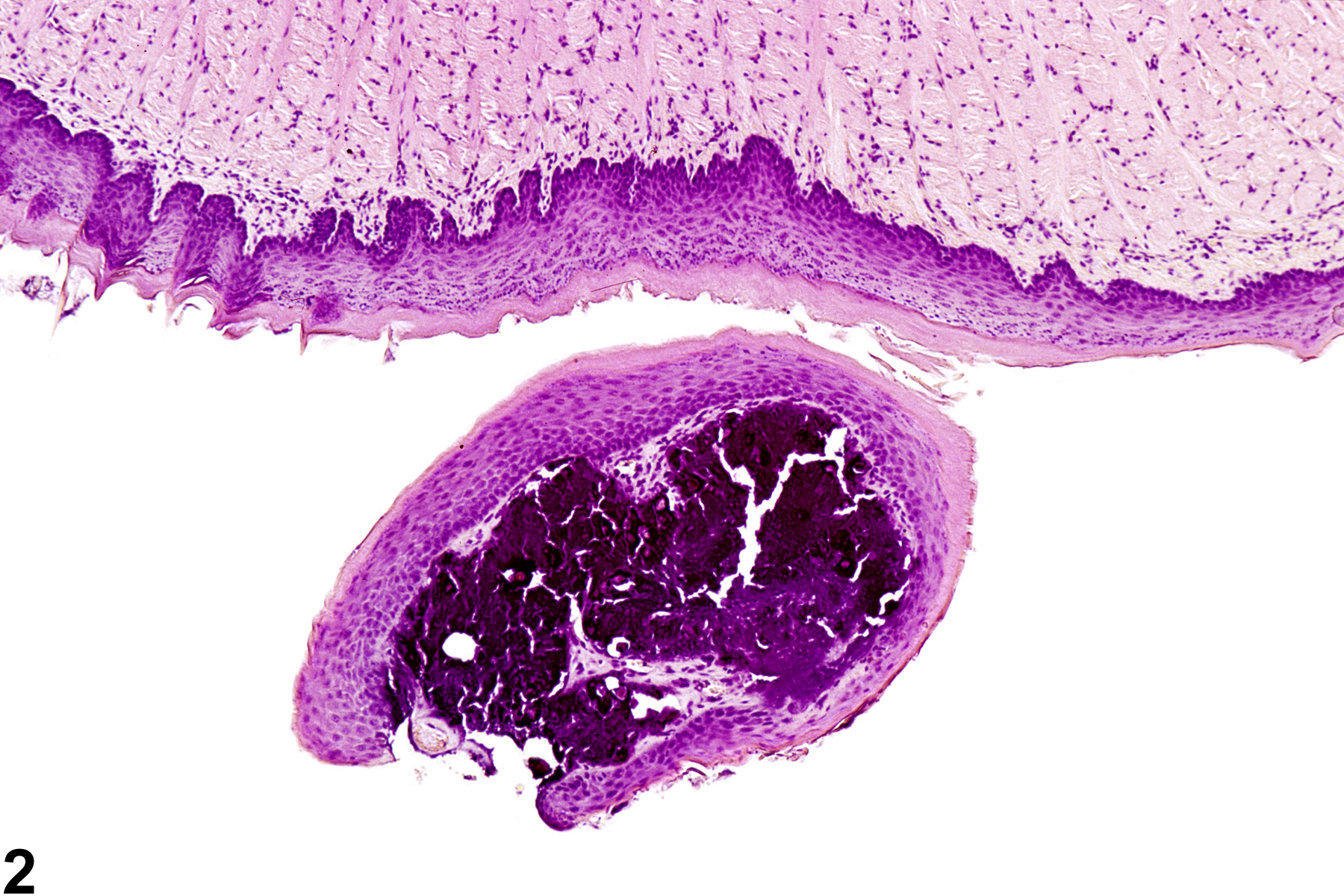 Image of fibroepithelial polyp in the tongue mucosa from a male B6C3F1 mouse in a chronic study