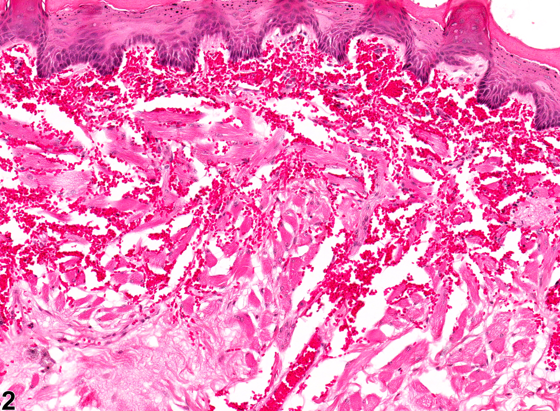 Image of hemorrhage in the tongue from a female F344/N rat in a chronic study