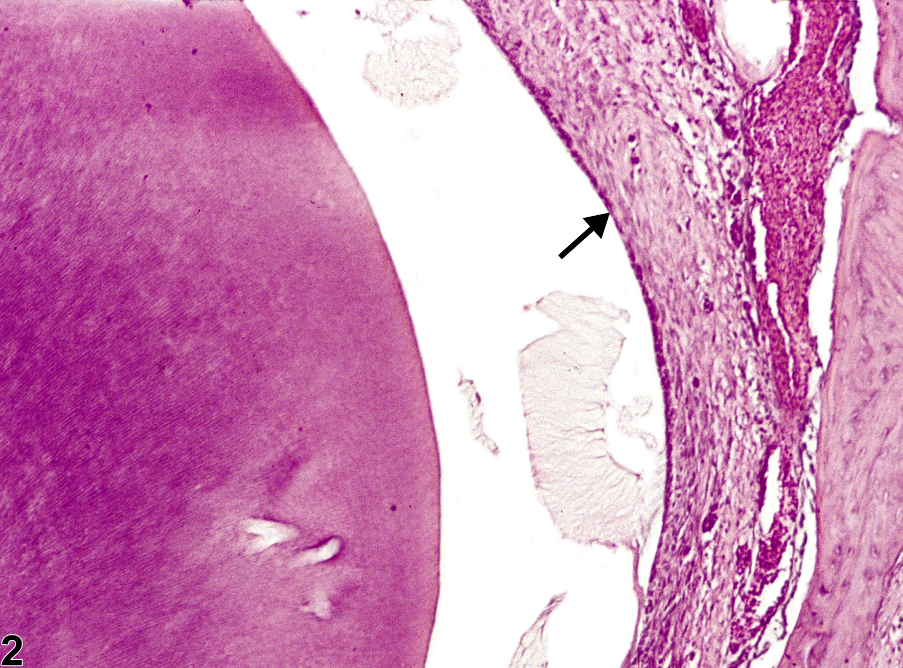 Image of atrophy in the tooth ameloblast from a male F344/N rat in a chronic study