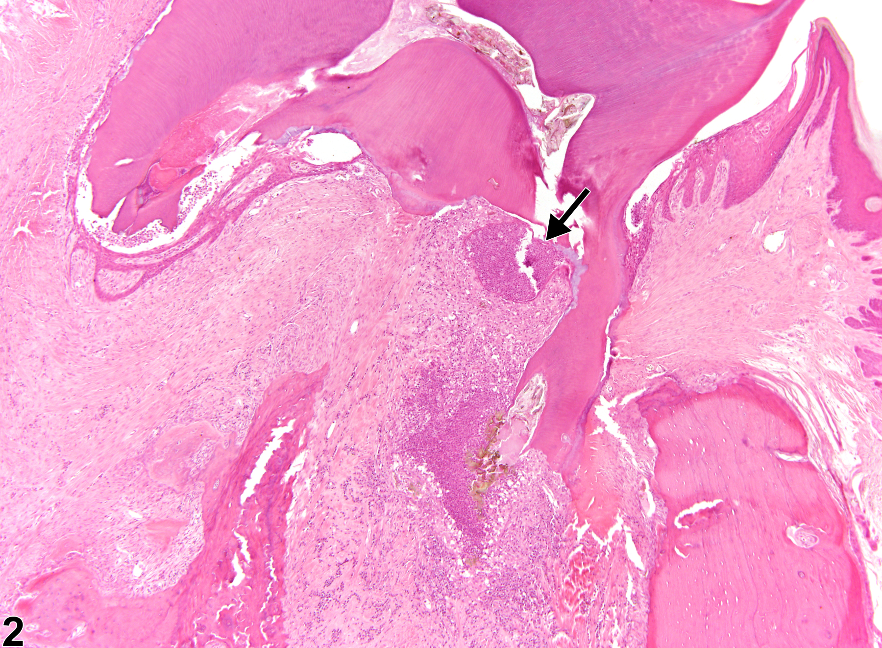 Image of inflammation in the tooth from a male HSD rat in a chronic study