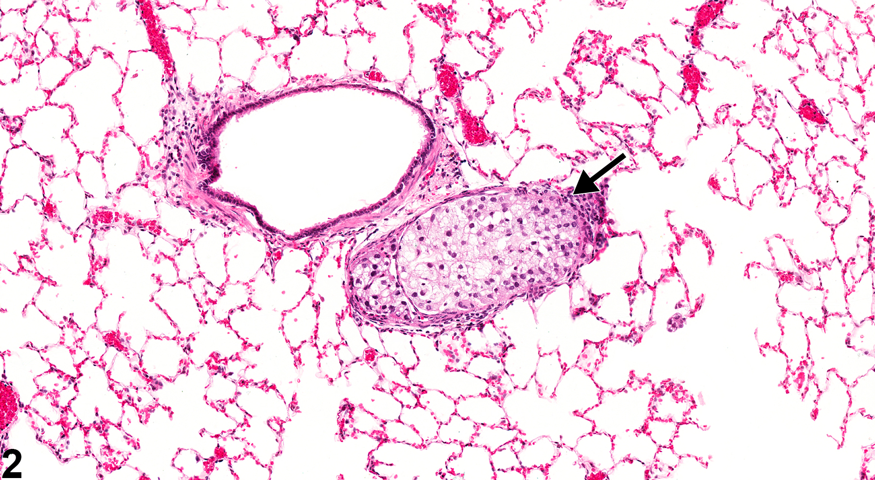Image of embolus in the lung, artery from a male F344/N rat in a chronic study