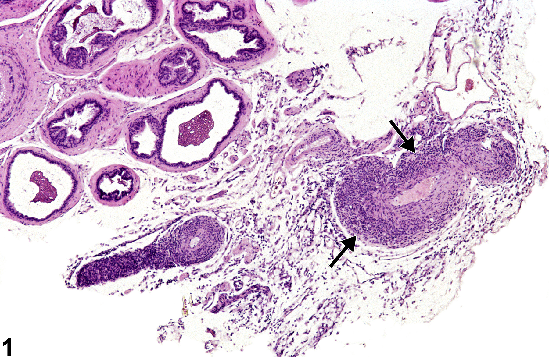 Image of polyarteritis nodosa in the prostate from a male B6C3F1/N mouse in a chronic study